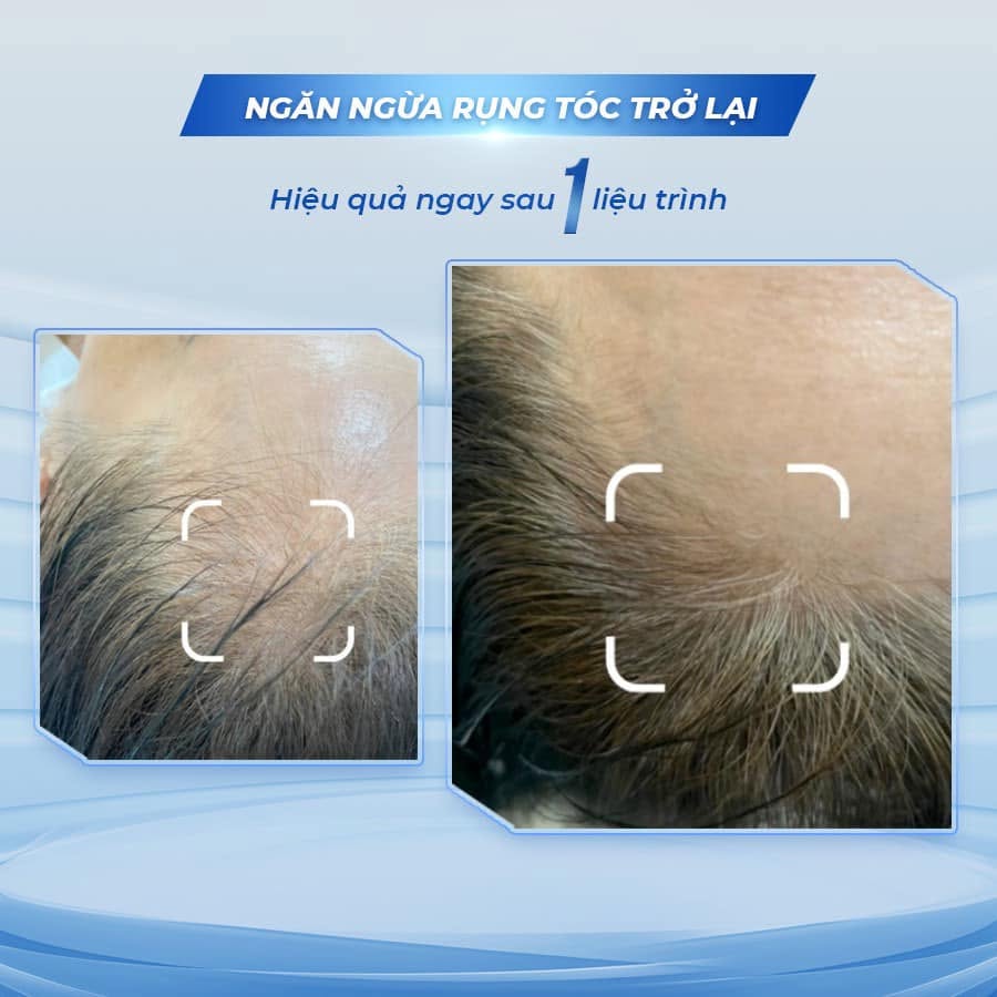 Bombit Hair Meso MSC Exosome hổ trợ mọc tóc, giảm rụng tóc