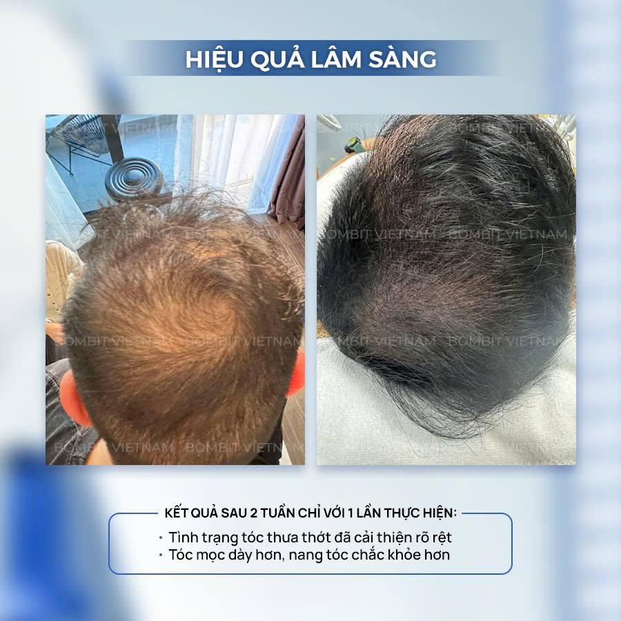 Bombit Hair Meso MSC Exosome hổ trợ mọc tóc, giảm rụng tóc