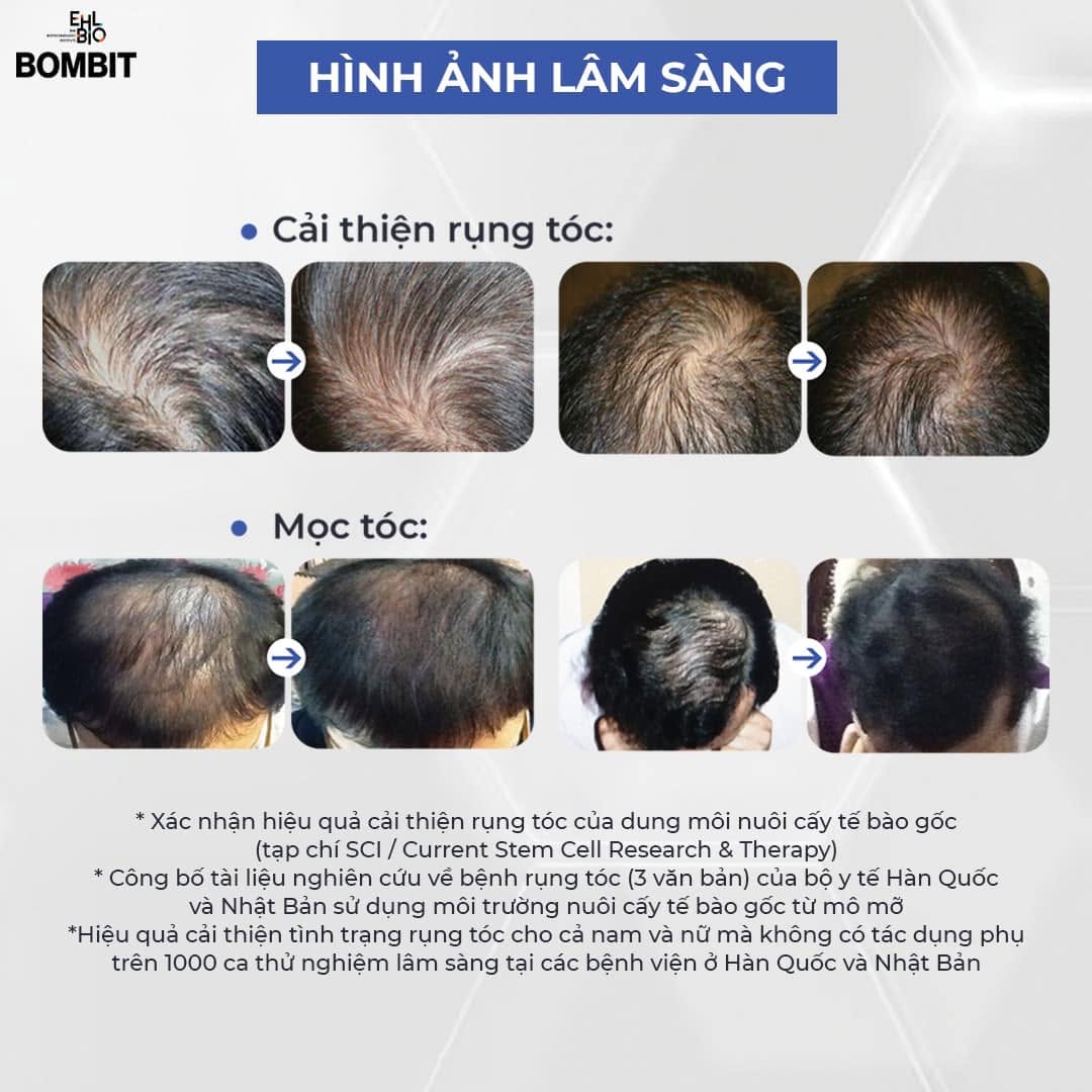 Bombit Hair Meso MSC Exosome hổ trợ mọc tóc, giảm rụng tóc