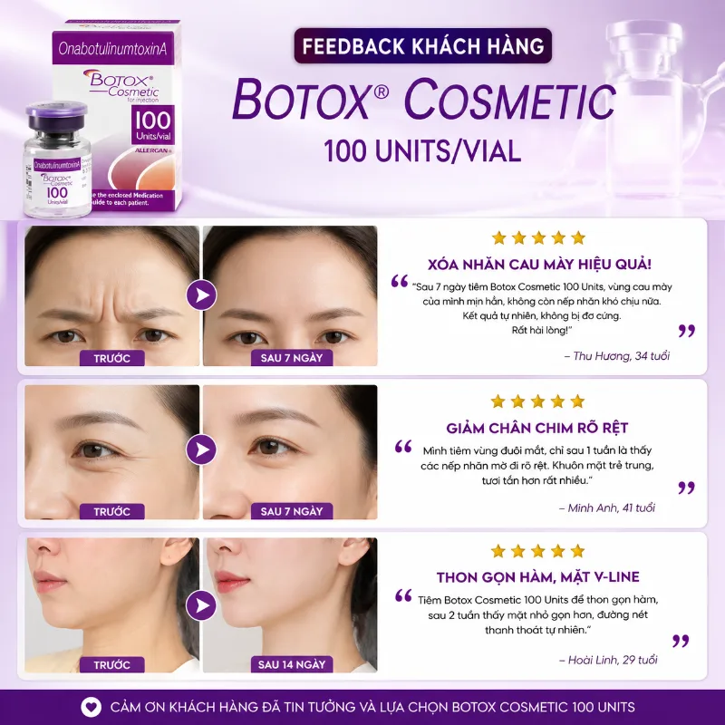 Botox Allergan Mỹ 100 Units – Giải pháp xóa nhăn & thon gọn
