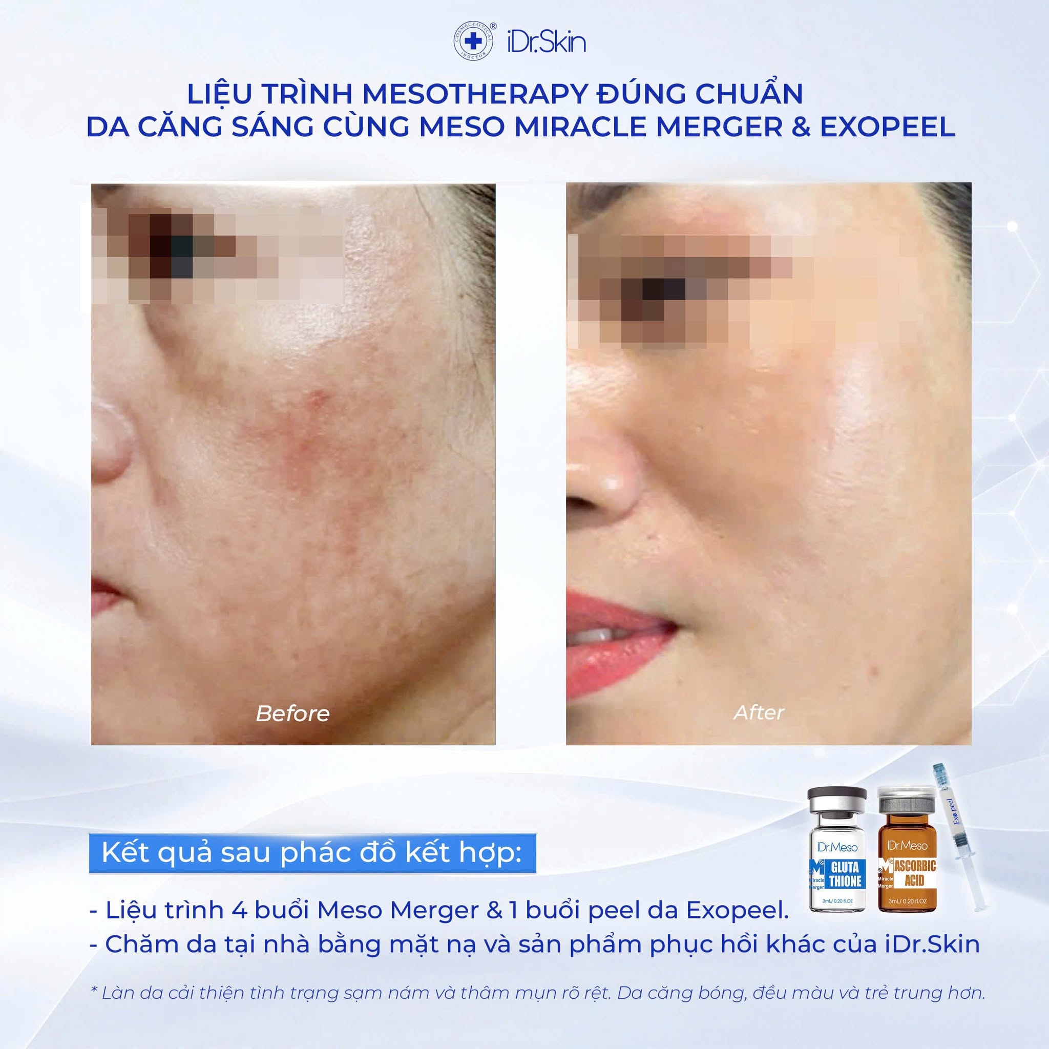 Combo meso Idr.Skin vitamin C 20% và Glutathion trắng sáng da