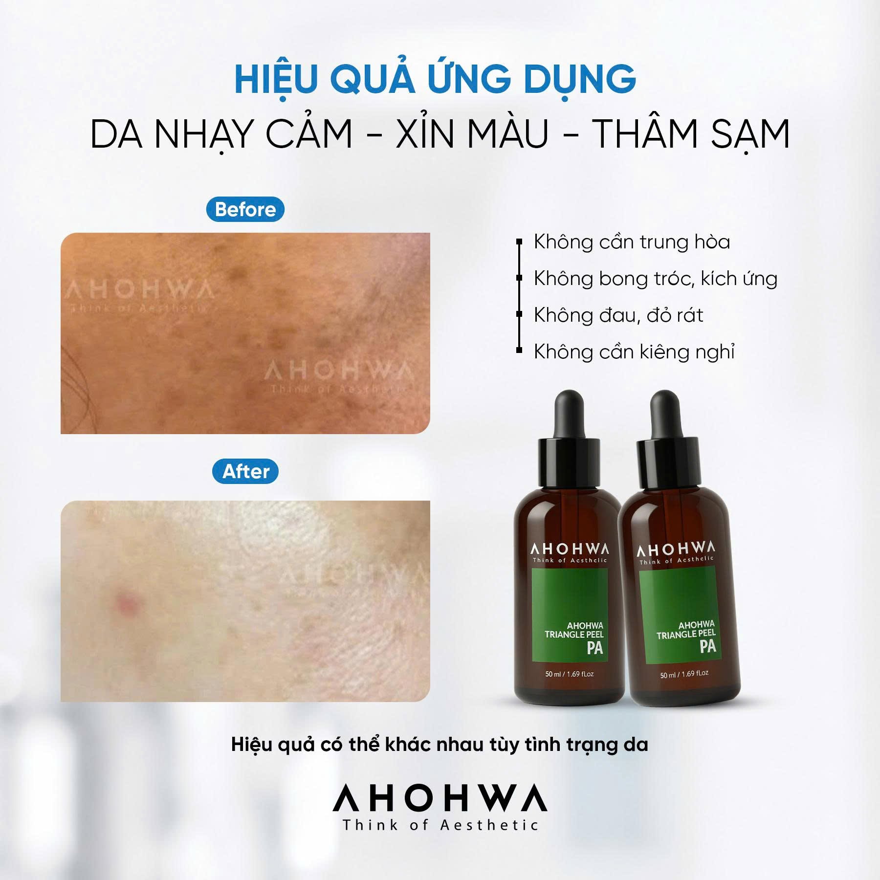 Dung dịch peel dành cho mọi loại da Ahohwa Triangle Peel Pa