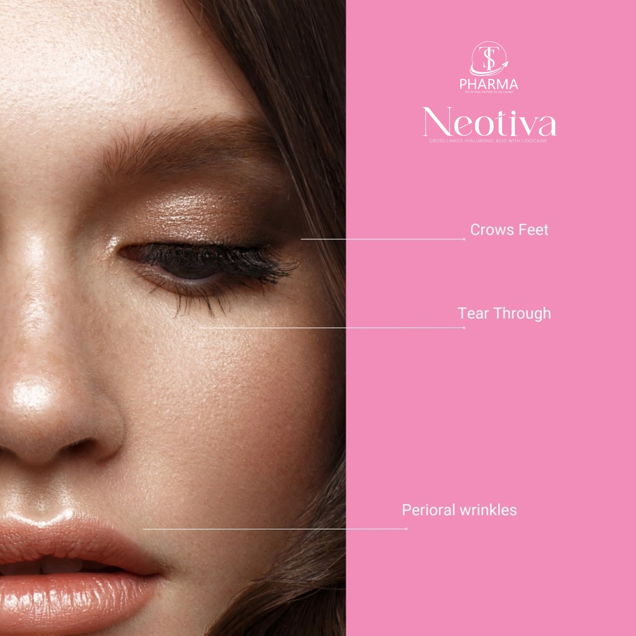 Filler HA Mềm Mại Tạo Hình Môi, Xóa Nhăn Tự Nhiên Filler Neotiva Soft+ Hàn Quốc
