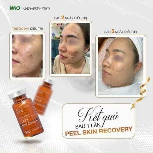 Peel Tái Tạo, Giảm Thâm Mụn, Trẻ Hóa Da Innoaesthetics Skin Recovery 1 LỌ