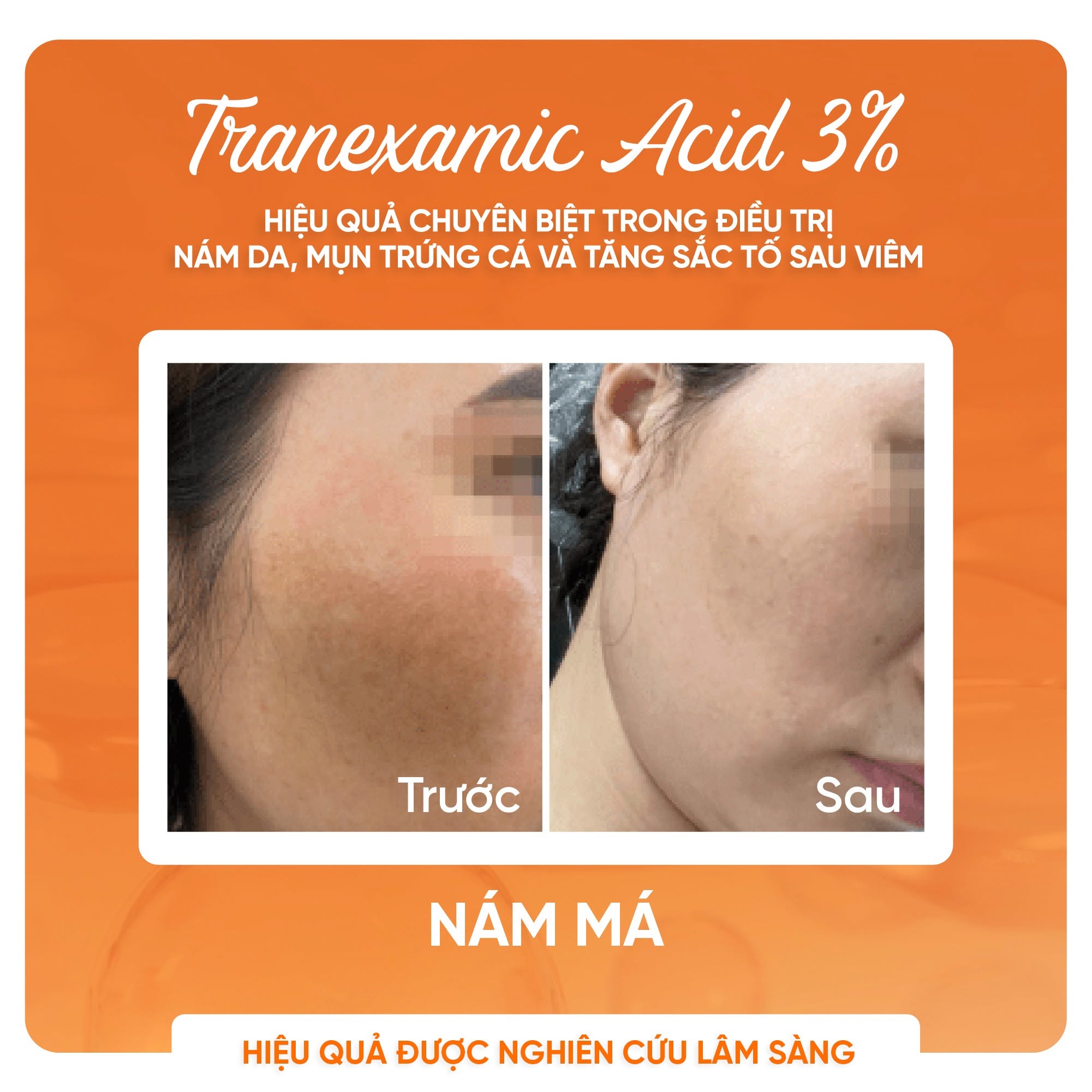 Kem Bôi Tranexamic Acid Hỗ Trợ Cải Thiện Nám, Hồng Ban Và Tăng Sắc Tố Tranacix Cream 3%