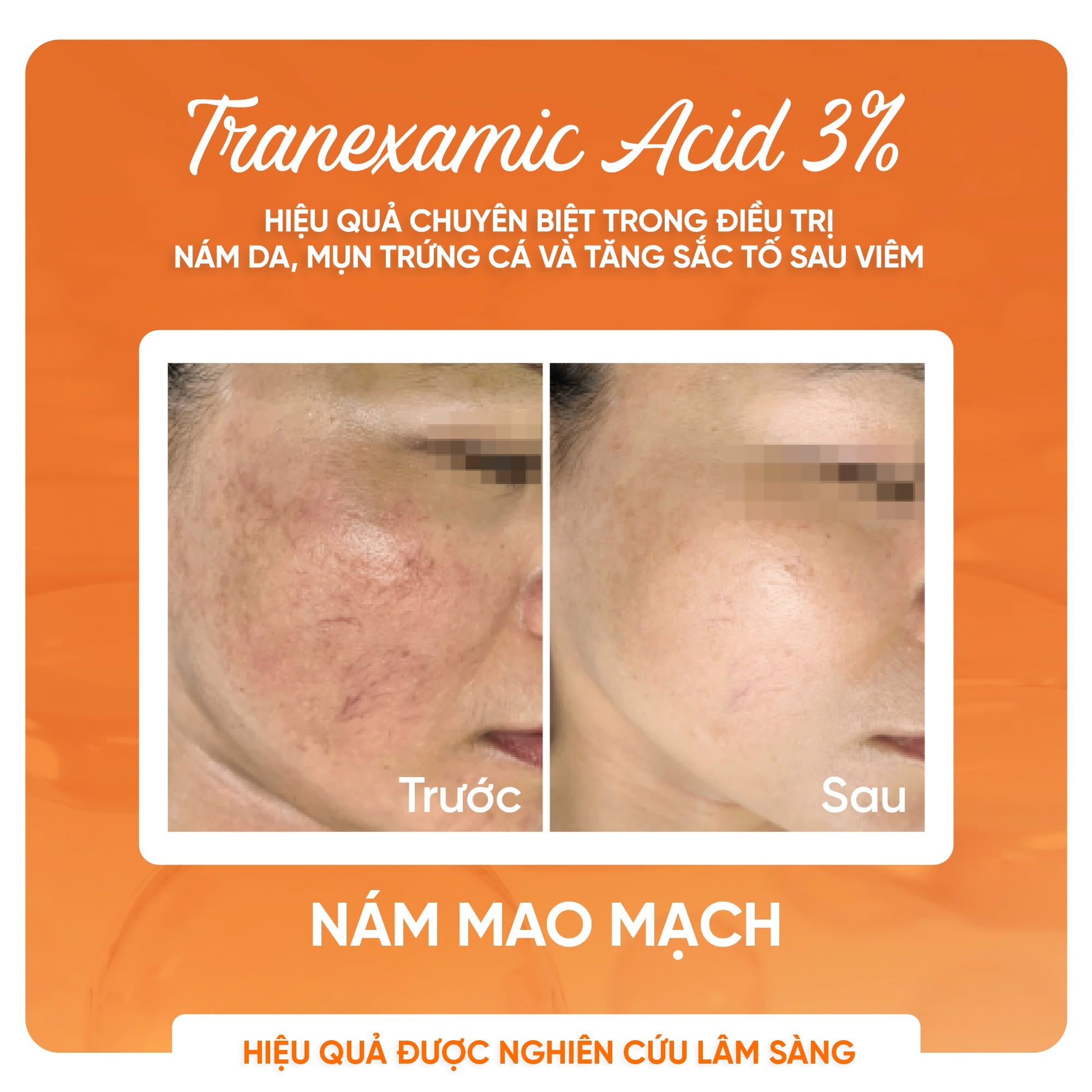 Kem Bôi Tranexamic Acid Hỗ Trợ Cải Thiện Nám, Hồng Ban Và Tăng Sắc Tố Tranacix Cream 3%