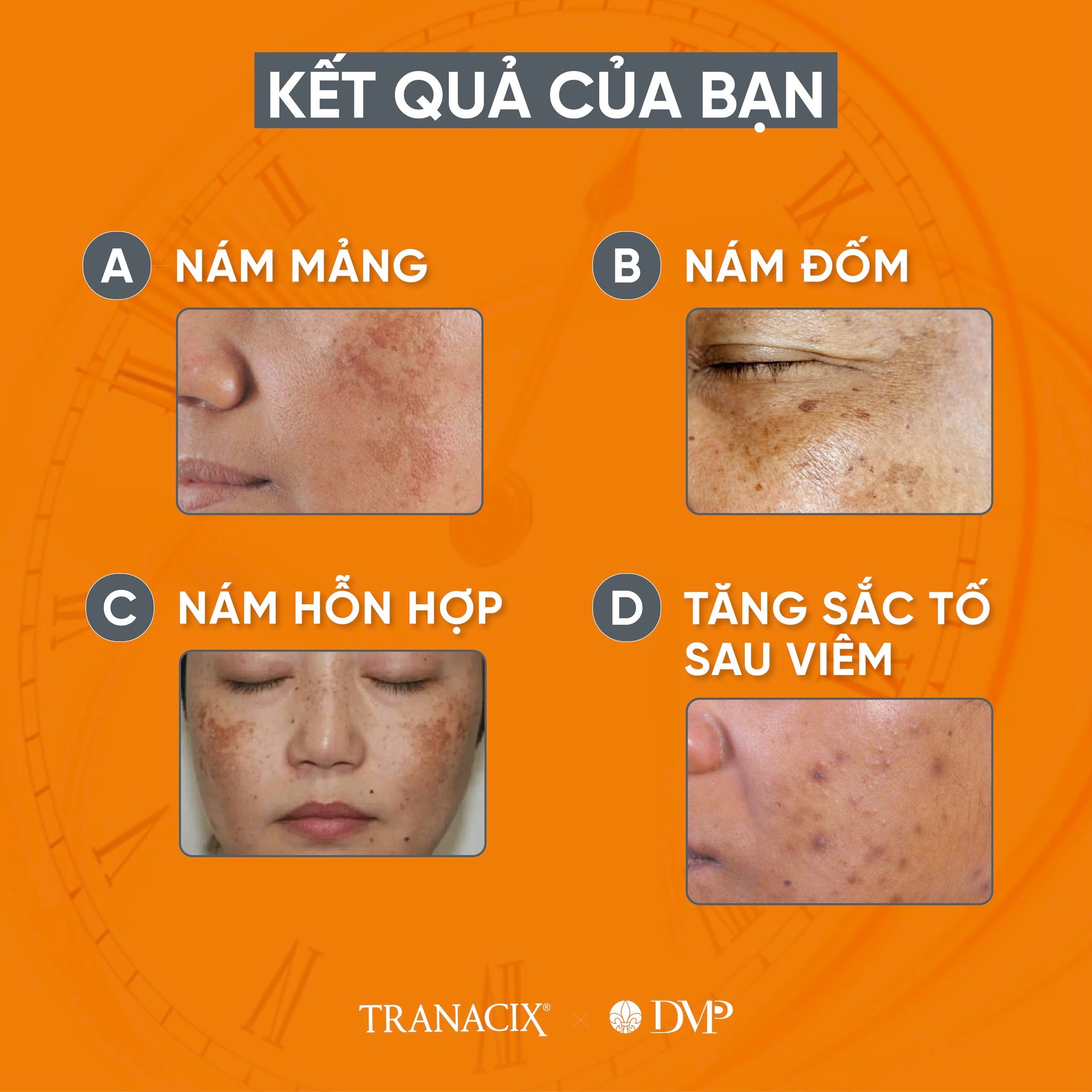 Kem Bôi Tranexamic Acid Hỗ Trợ Cải Thiện Nám, Hồng Ban Và Tăng Sắc Tố Tranacix Cream 3%