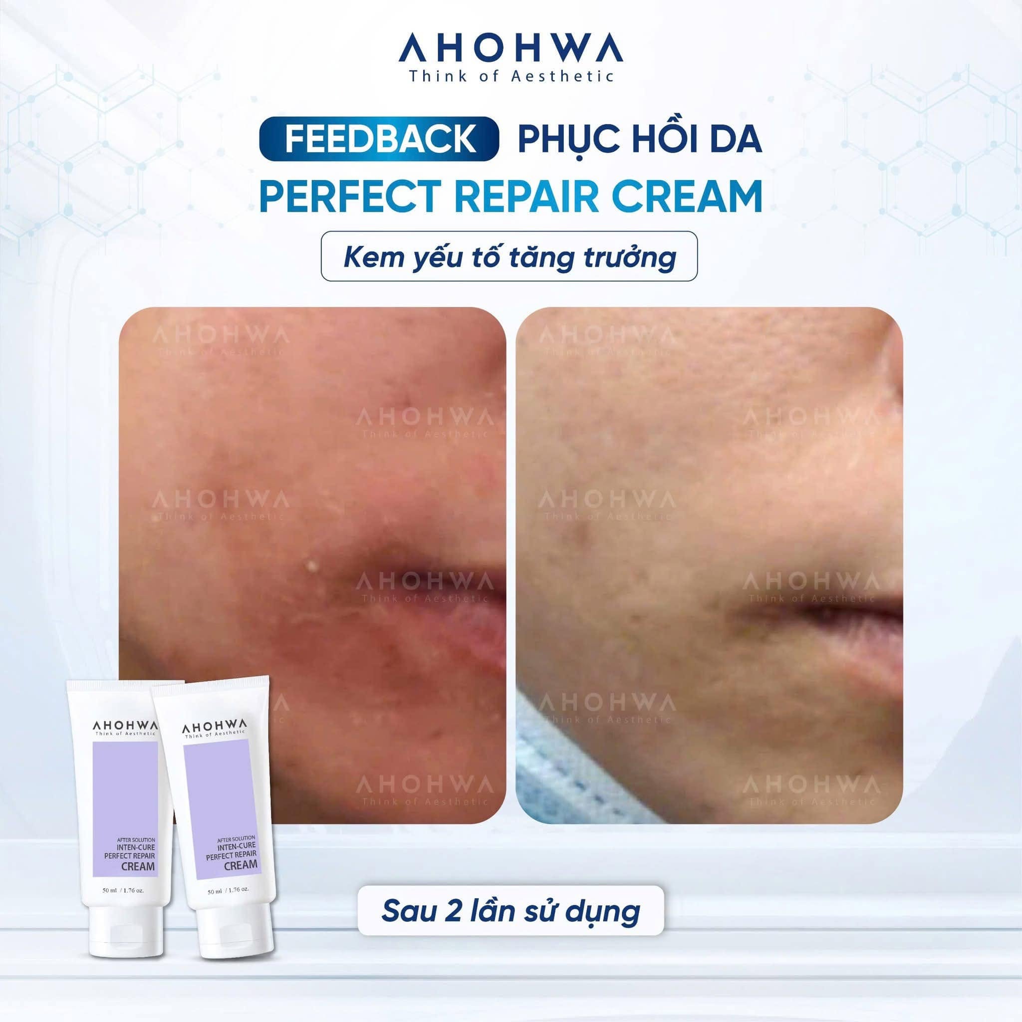 Kem tăng trưởng phục hồi da treatment Ahohwa After Solution Inten-Cure Perfect Repair Cream 50ml