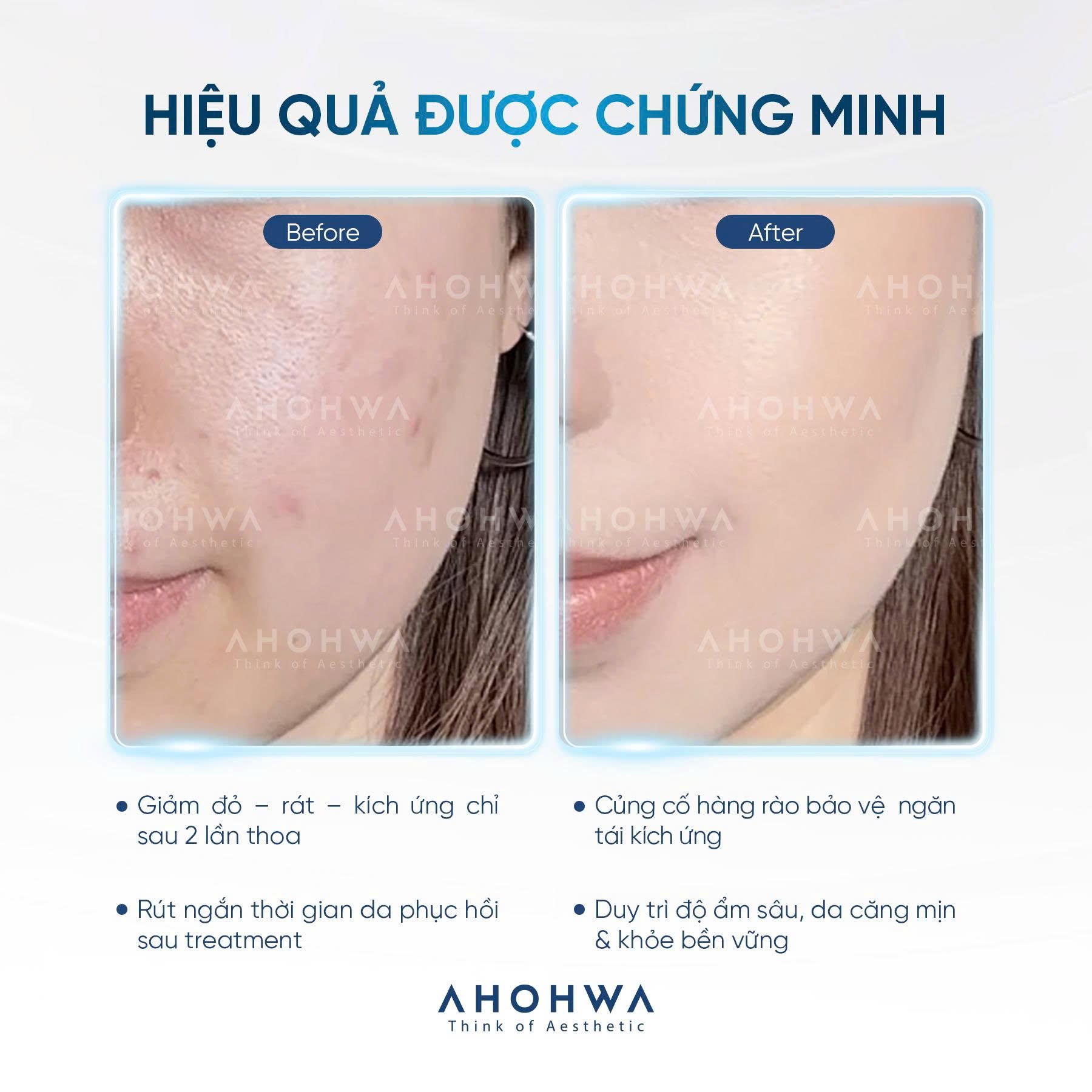 Kem tăng trưởng phục hồi da treatment Ahohwa After Solution Inten-Cure Perfect Repair Cream 50ml