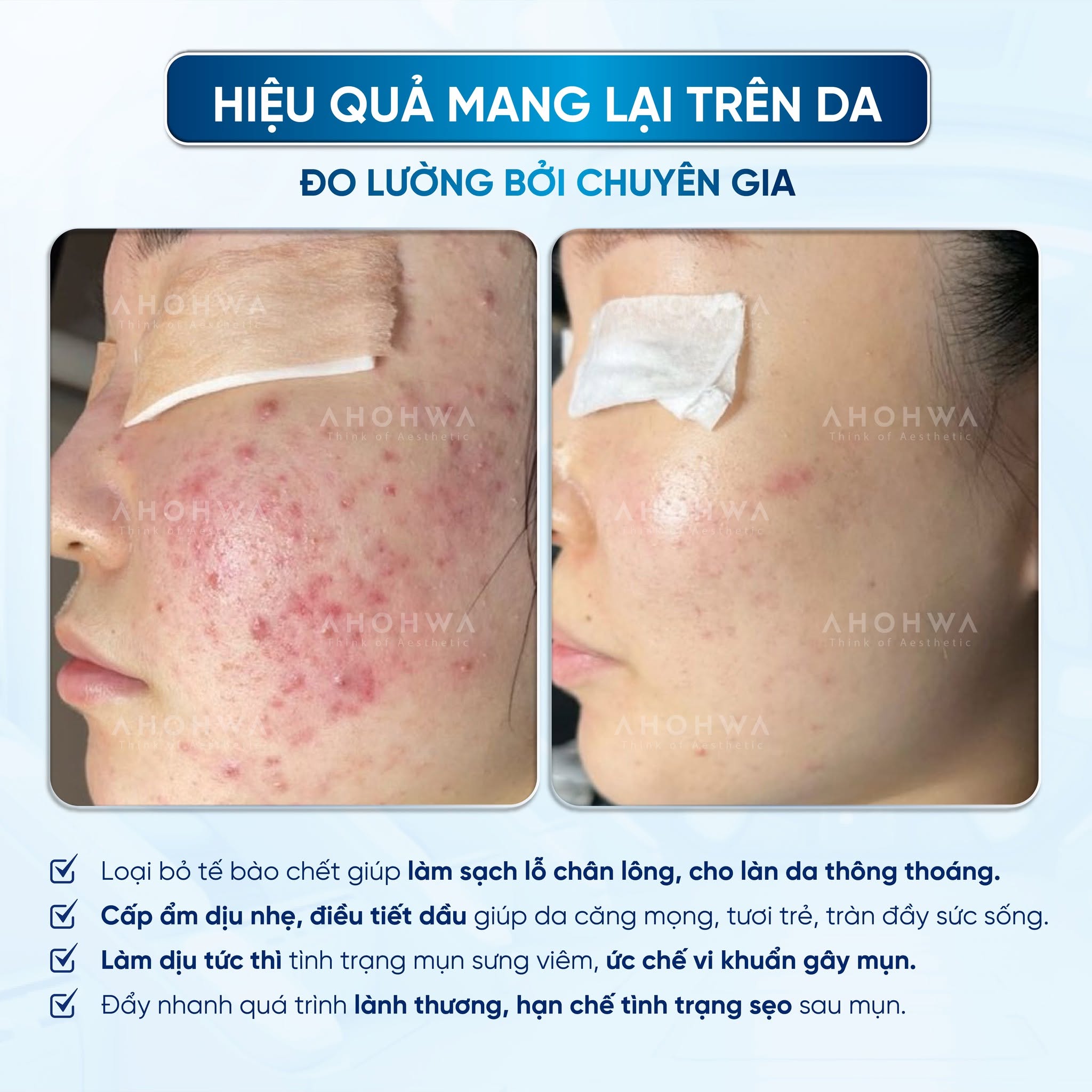Kem dưỡng ẩm giảm mụn trứng cá Ahohwa Acless Solution Control Clear Cream