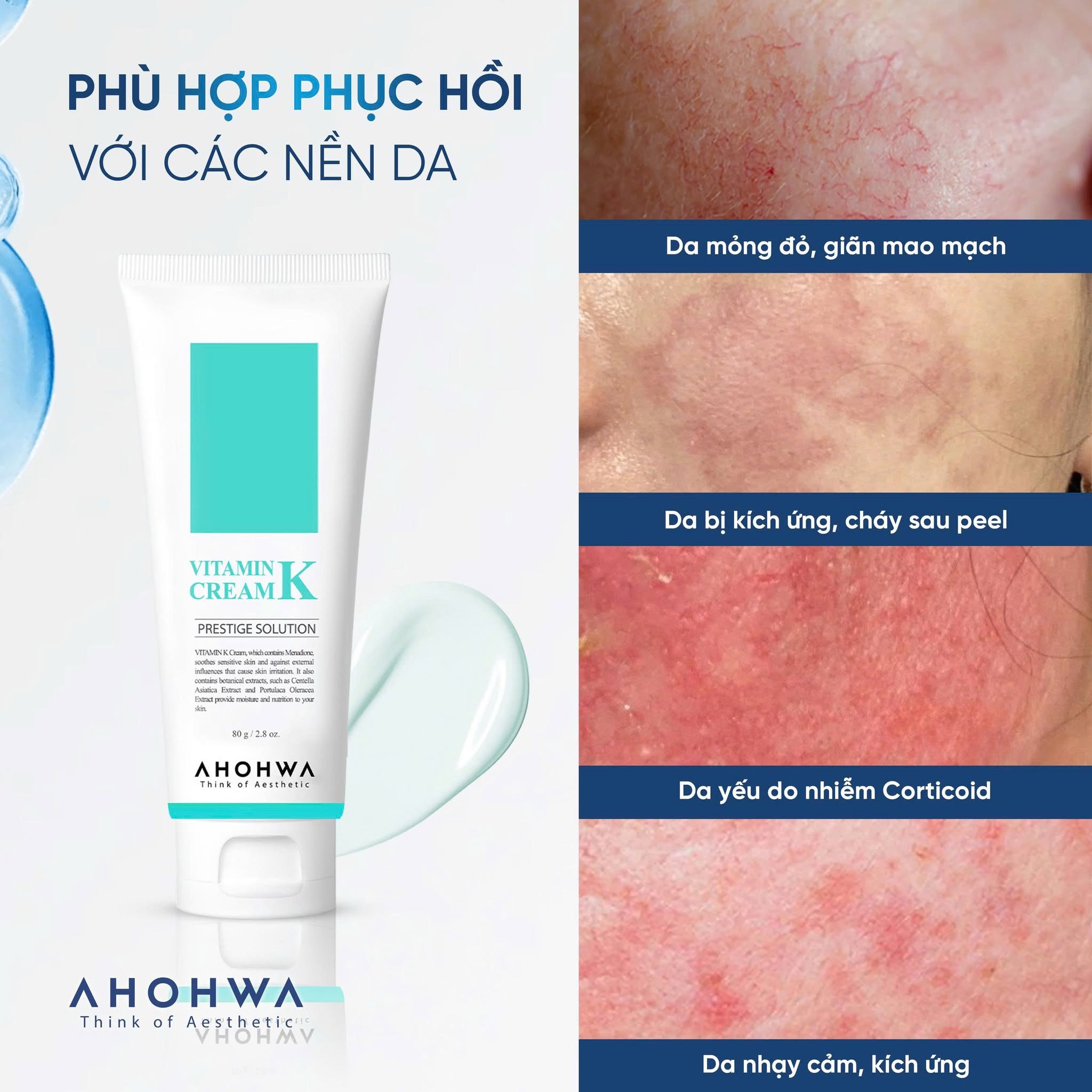 Kem phục hồi da giãn mao mạch da nhiễm corticoid Ahohwa Prestige Solution Vitamin K Cream