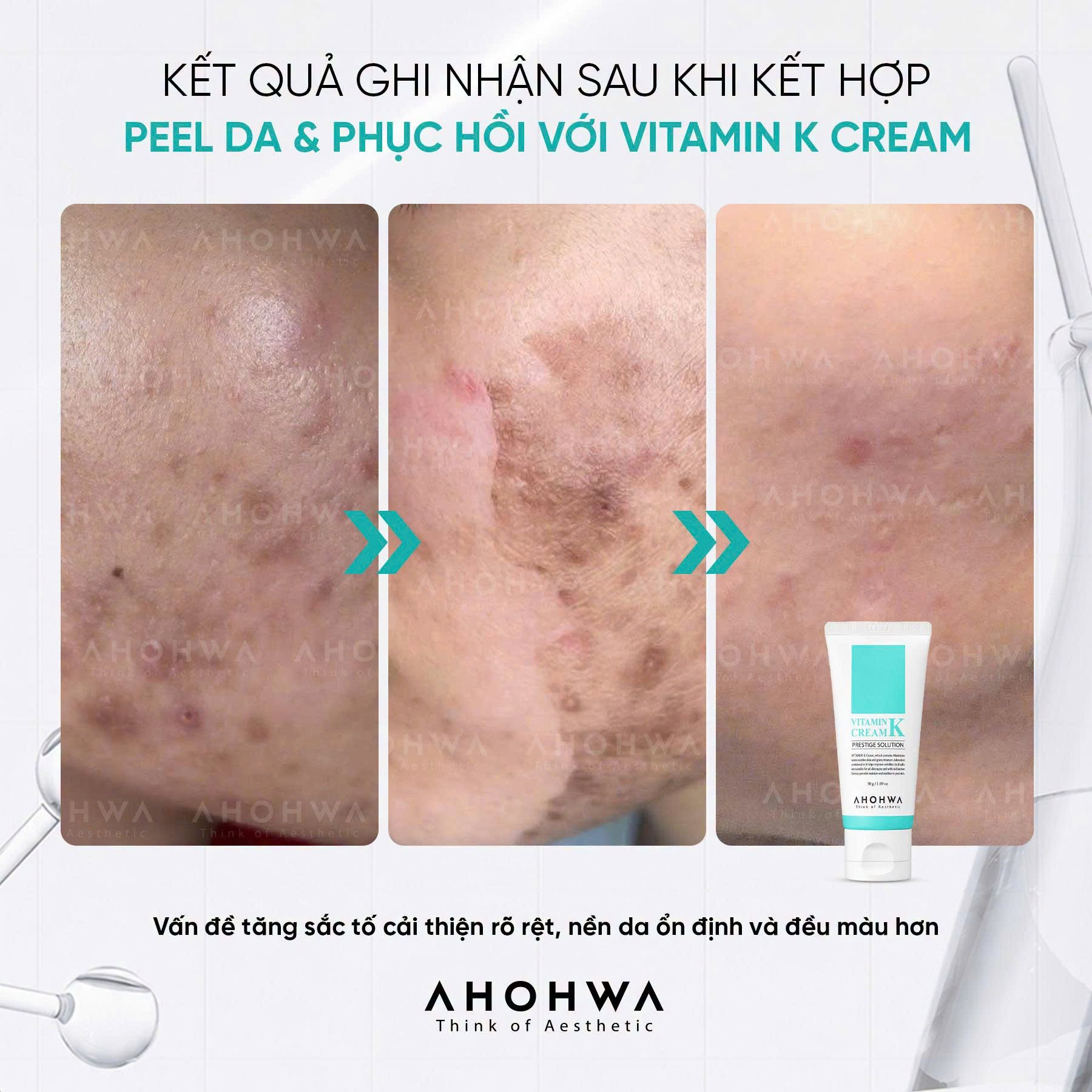 Kem phục hồi da giãn mao mạch da nhiễm corticoid Ahohwa Prestige Solution Vitamin K Cream