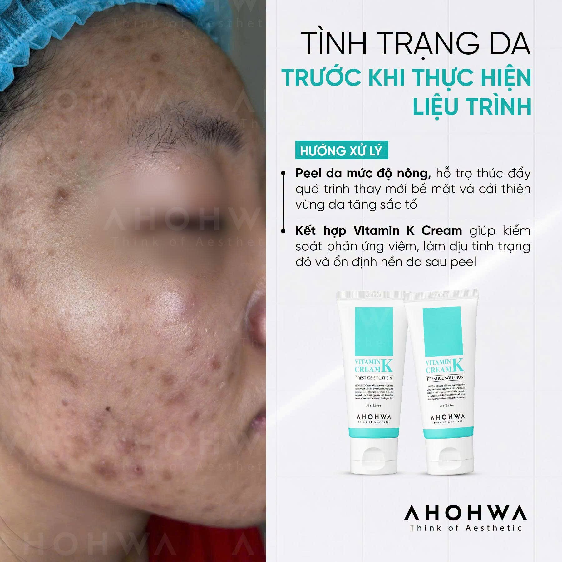 Kem phục hồi da giãn mao mạch da nhiễm corticoid Ahohwa Prestige Solution Vitamin K Cream
