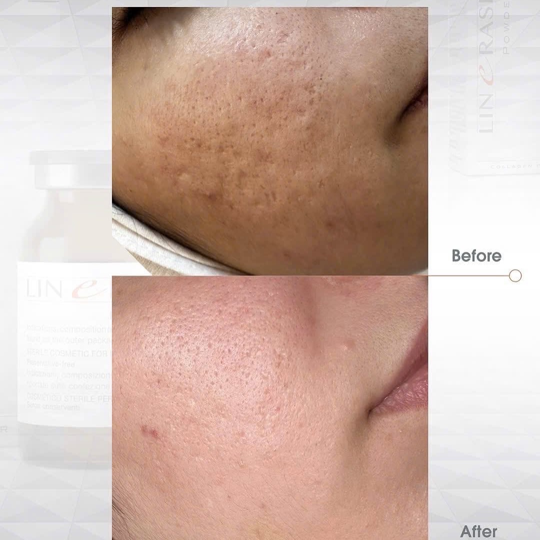 LINERASE COLLAGEN - PHỤC HỒI VÀ TÁI TẠO THẾ HỆ MỚI