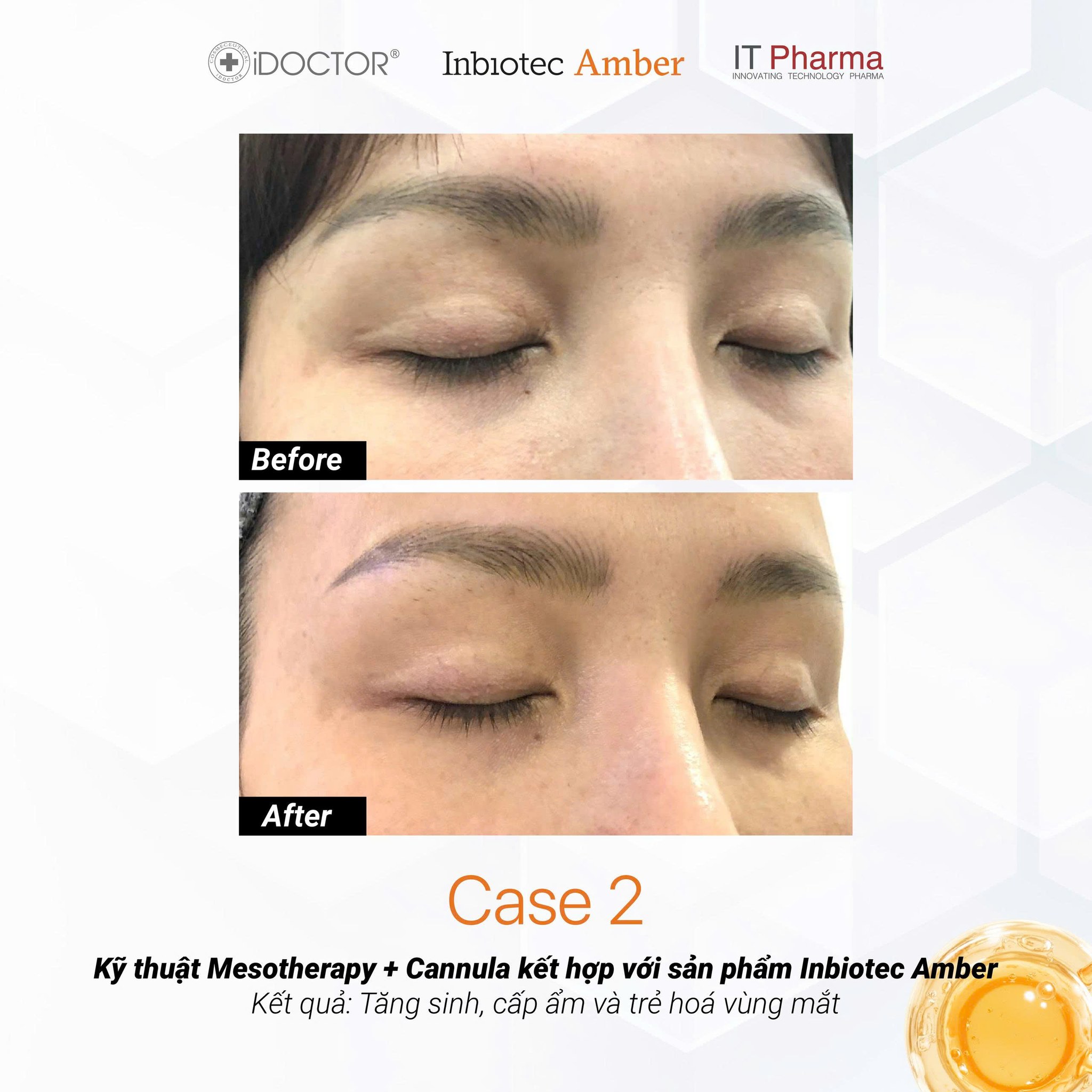 Liệu Trình Tiêm BAP Inbiotec Amber: Phác Đồ Phục Hồi & Trẻ Hóa Da Italy