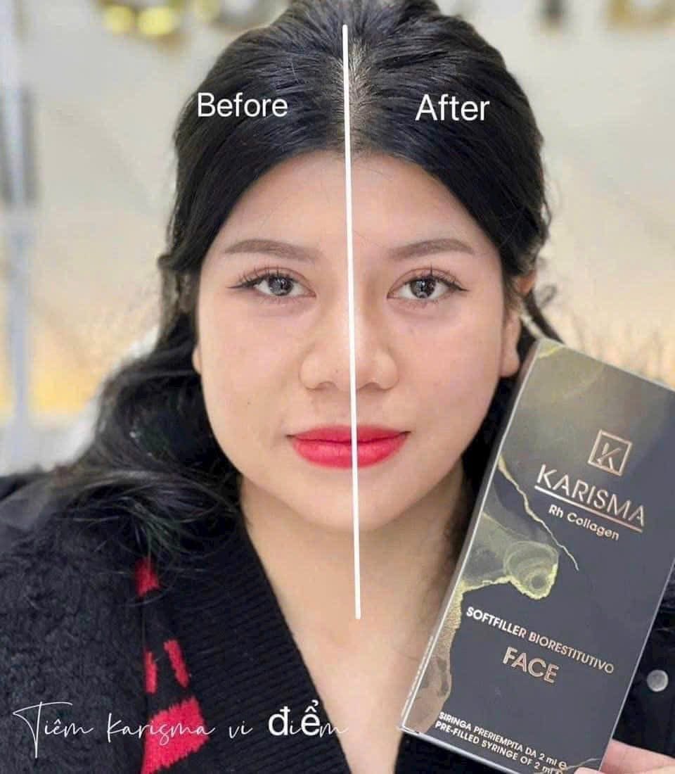 Liệu Trình Tiêm BAP Karisma: Phục Hồi Bằng Collagen Tái Tổ Hợp K15+