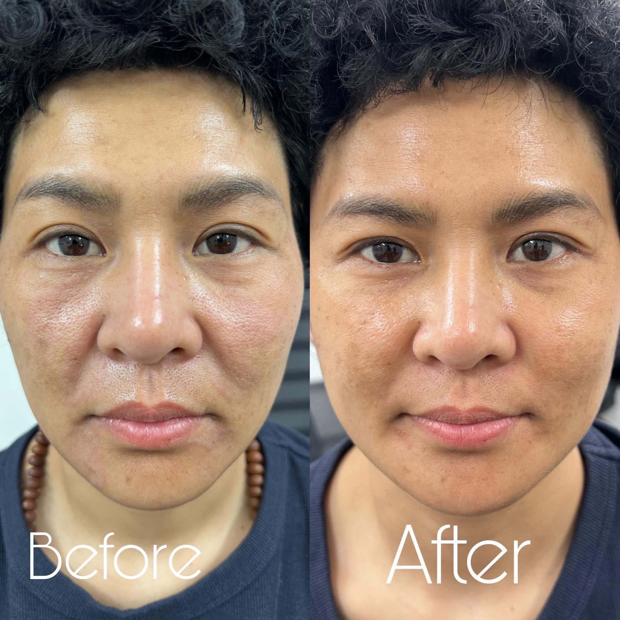 Liệu Trình Tiêm BAP Karisma: Phục Hồi Bằng Collagen Tái Tổ Hợp K15+