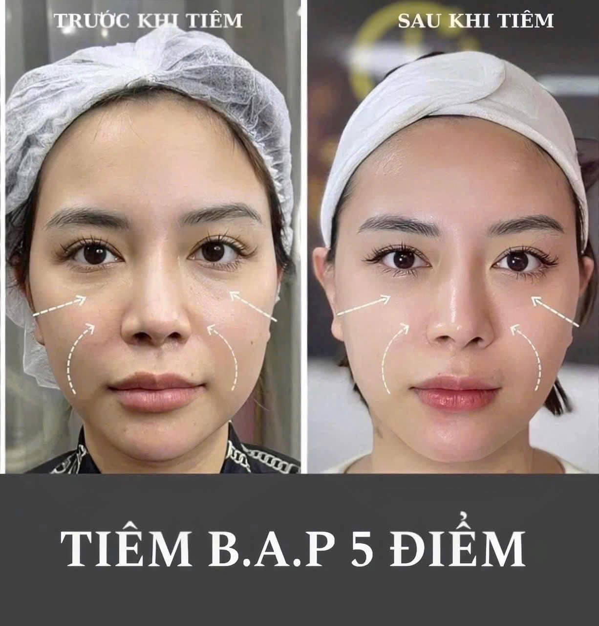 Liệu Trình Tiêm BAP Profhilo: Tinh Chất Trẻ Hóa Và Nâng Cơ Toàn Diện Chuẩn Y Khoa