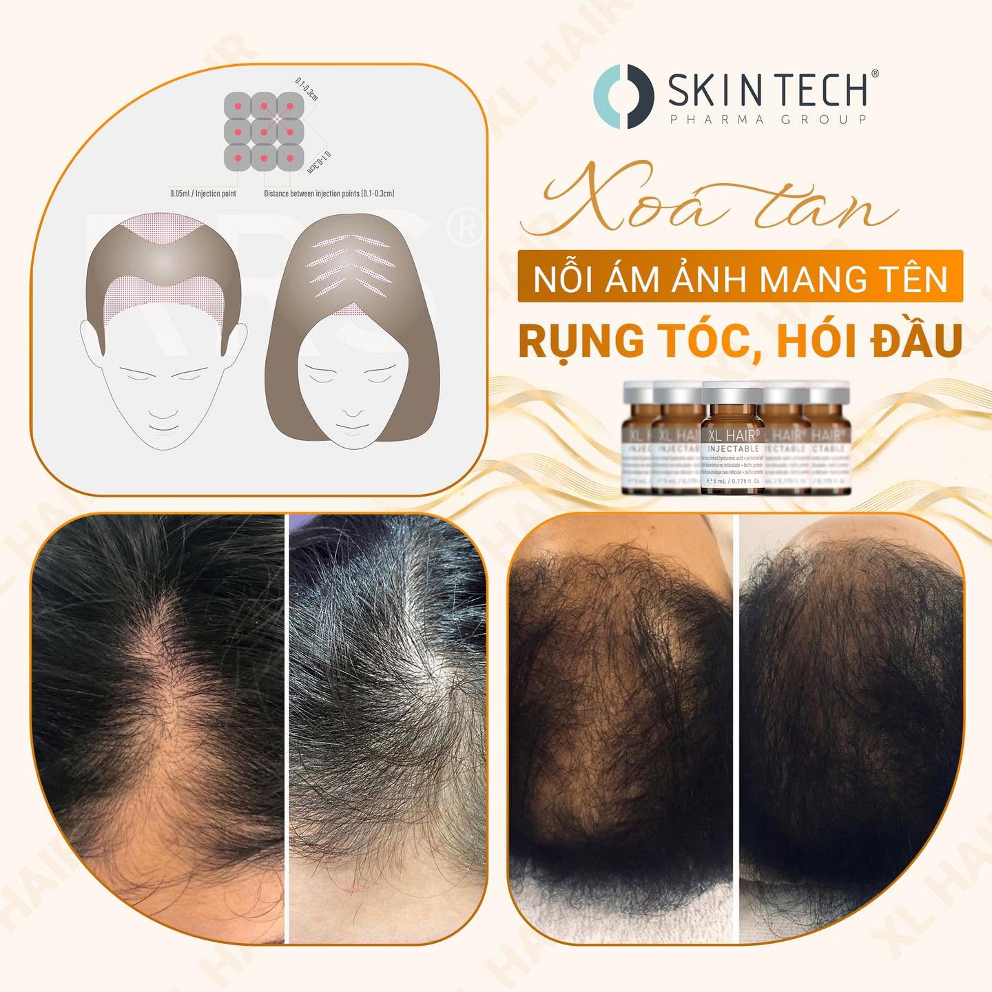 MESO KÍCH THÍCH MỌC TÓC XL HAIR SKIN TECH 5ML