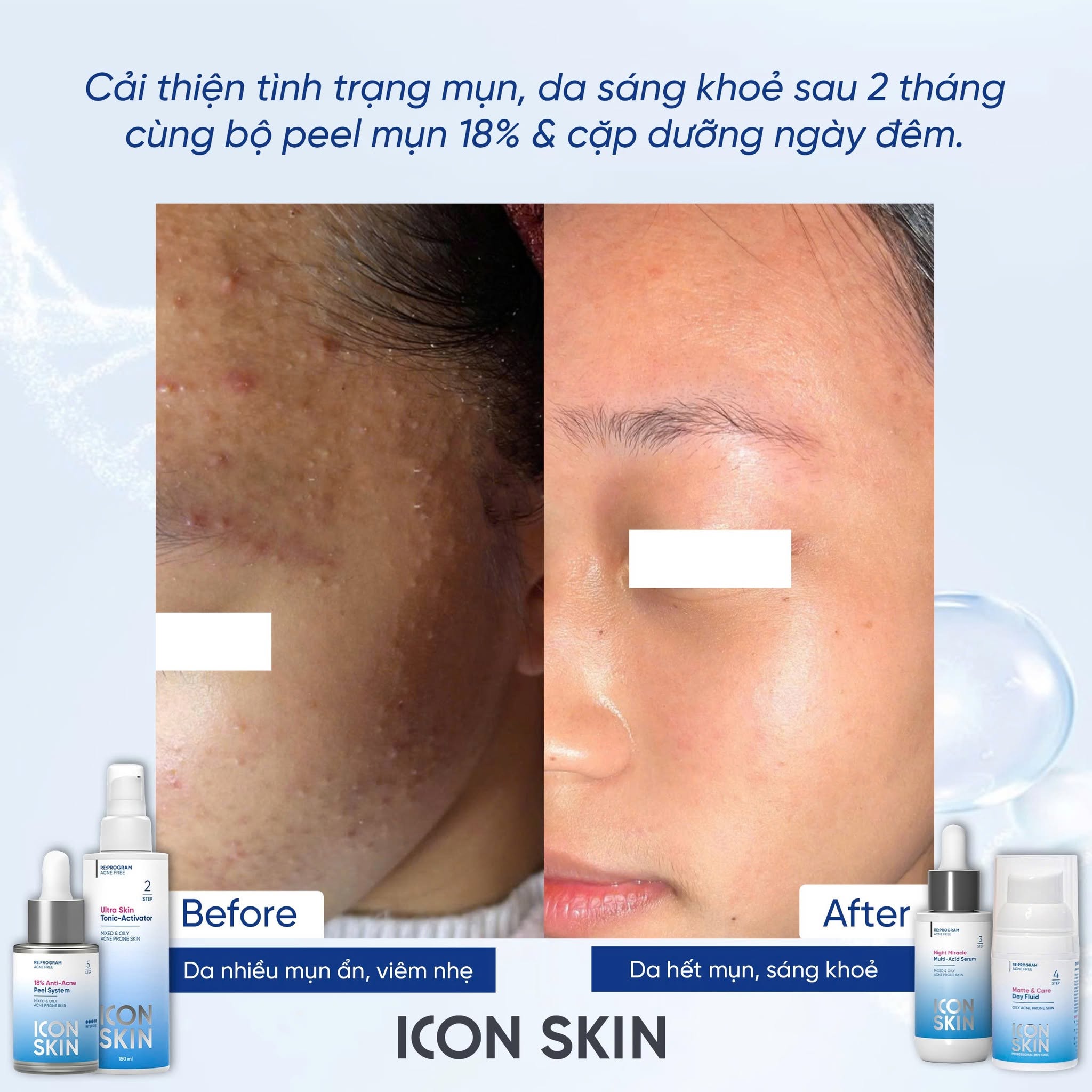 Nước cân bằng cho da dầu, da hỗn hợp Icon Skin Ultra Skin Tonic-Activator