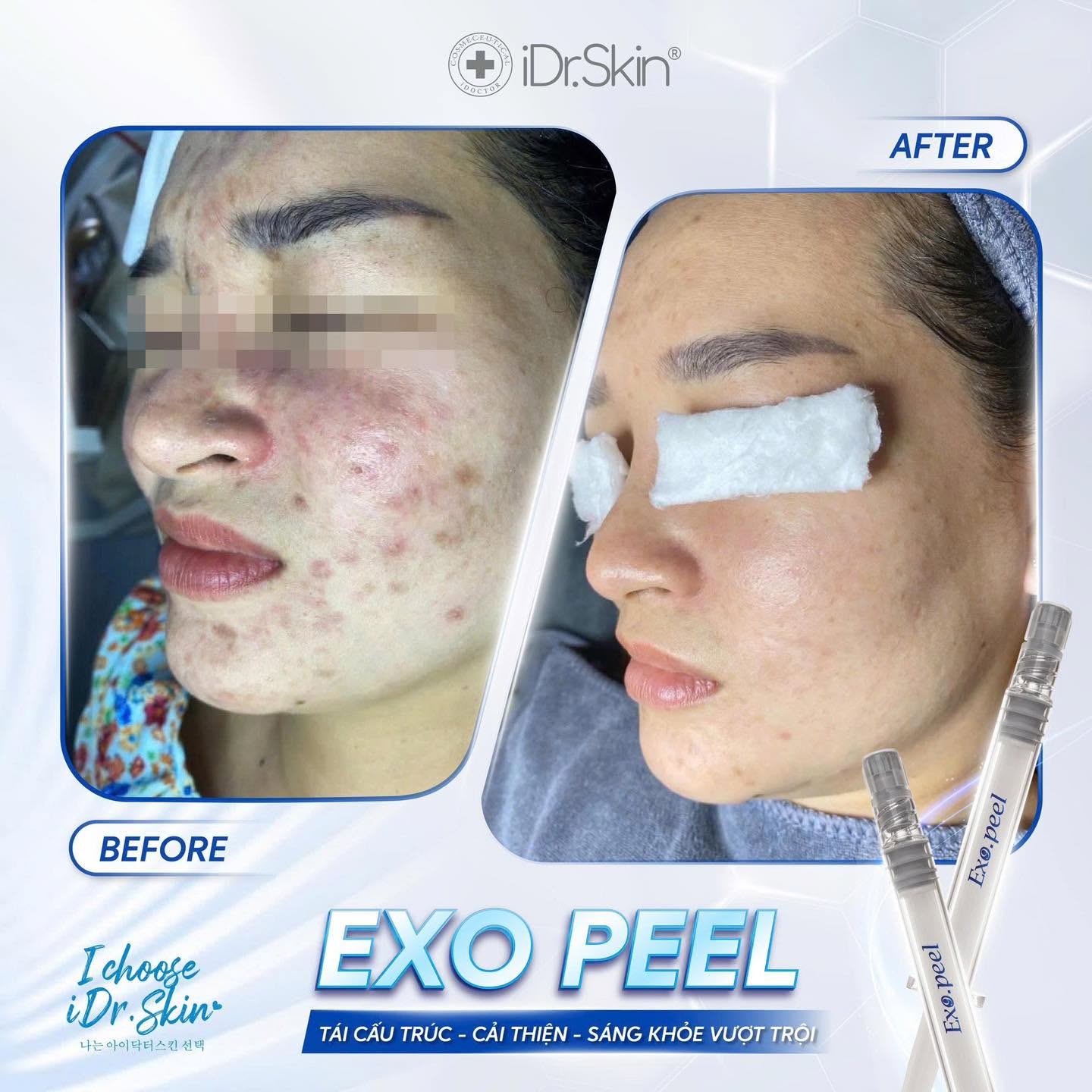 Peel Vật Lý Căng Bóng Da iDr.Skin iDr.Exo Peel Chính Hãng