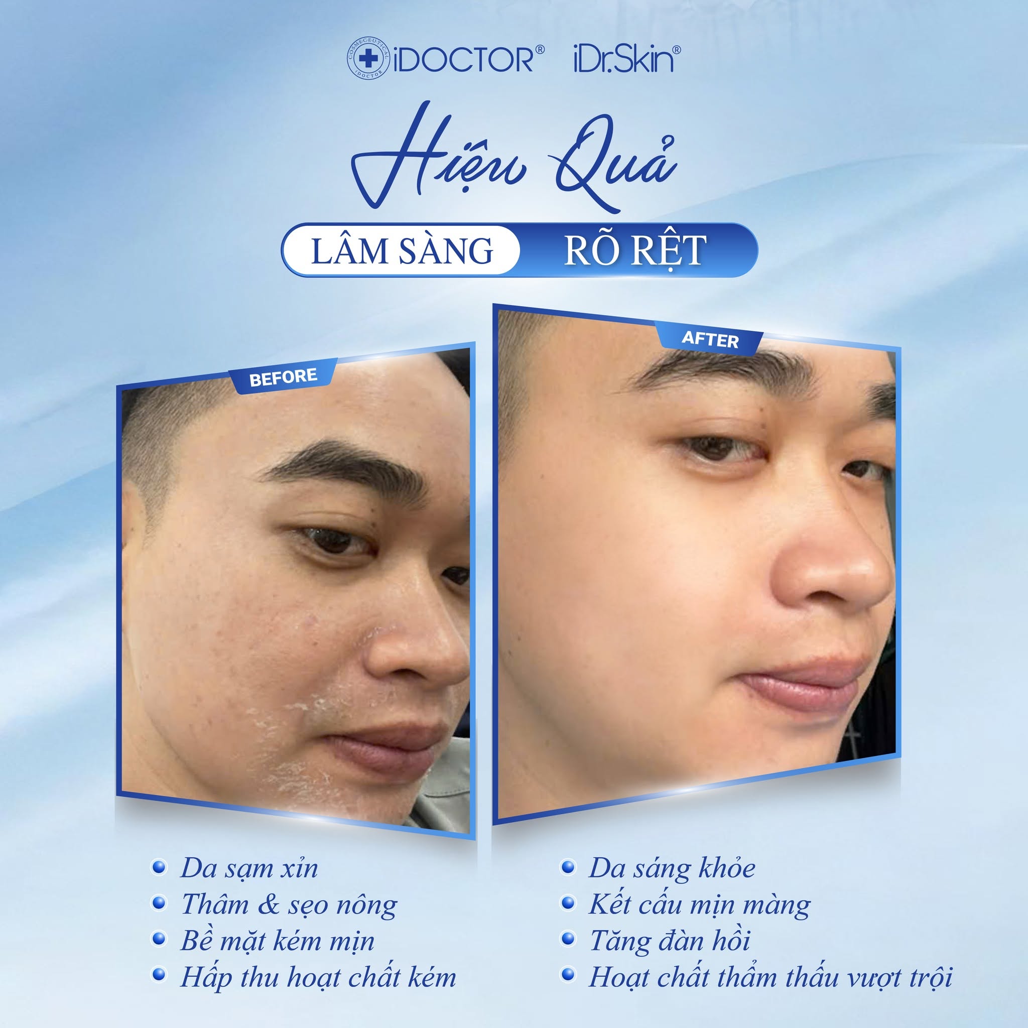 Peel Vật Lý Căng Bóng Da iDr.Skin iDr.Exo Peel Chính Hãng