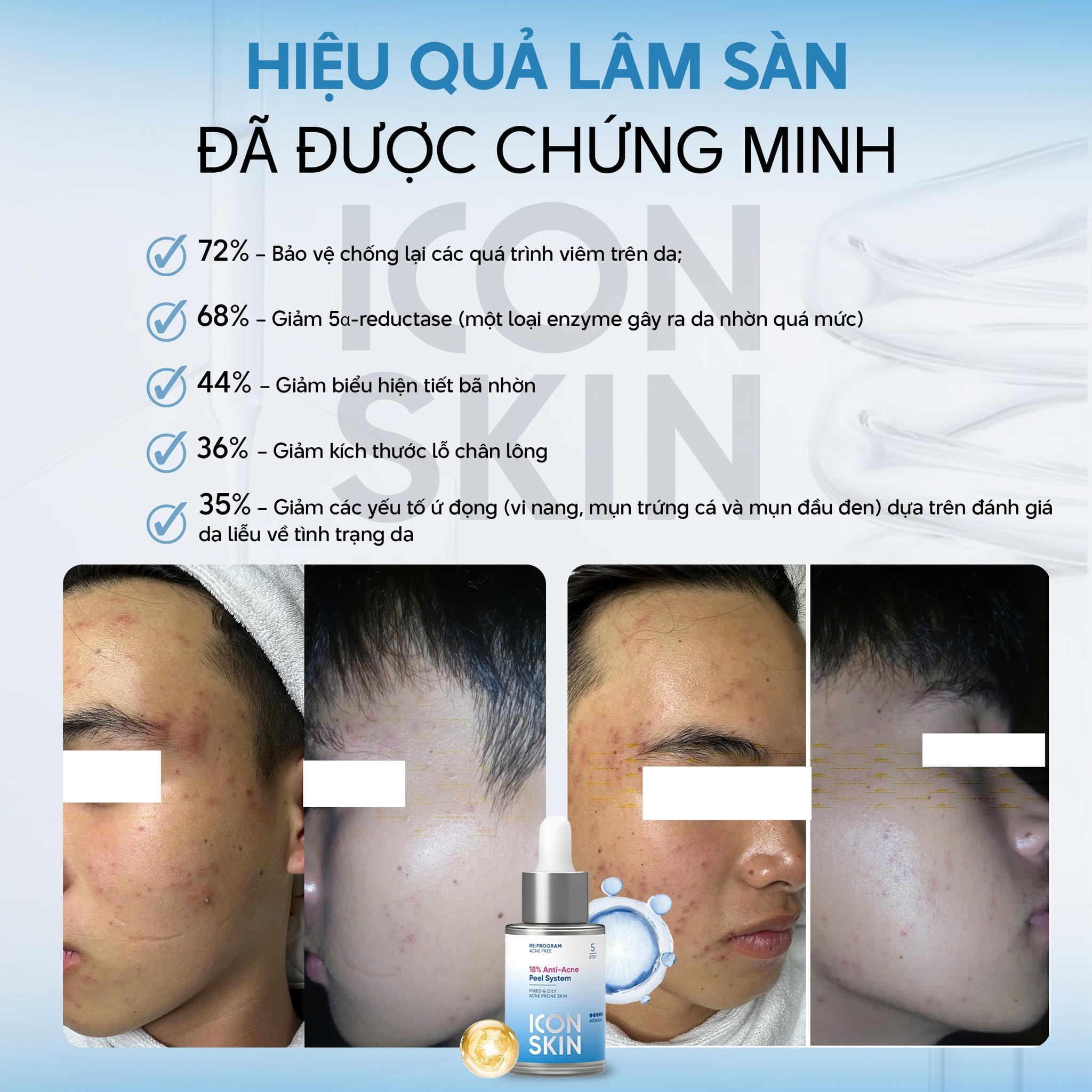 Peel da không bong cho da dầu, da hỗn hợp Icon Skin 18% Anti-Acne Peel System