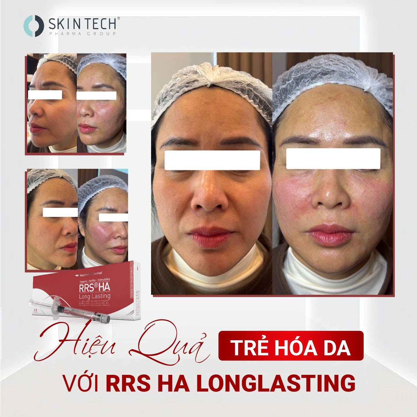 SkinTech RRS HA Long Lasting – Hoạt Chất HA Liên Kết Chéo Nâng Cơ Và Trẻ Hóa Da