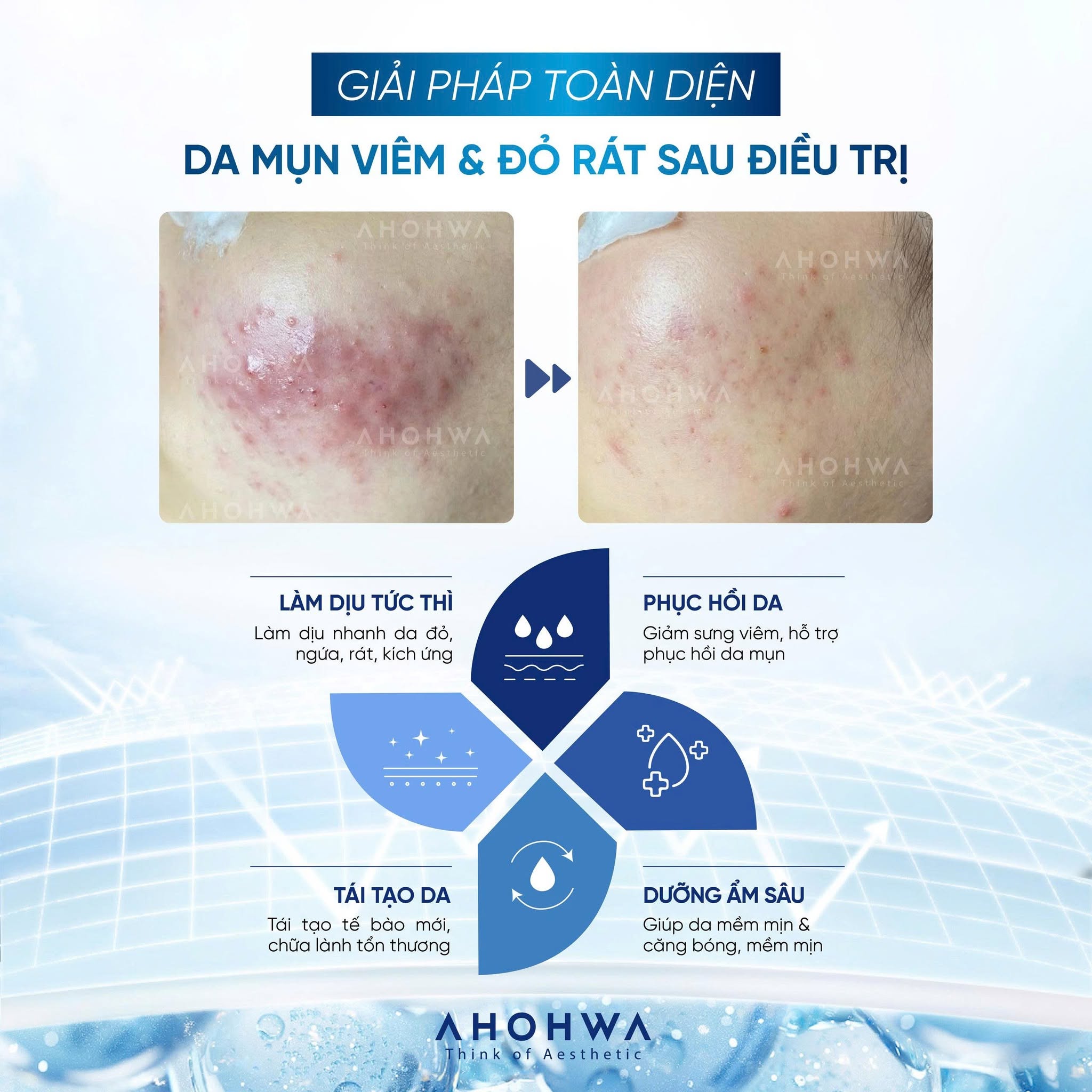 Tế bào gốc kháng viêm phục hồi tái tạo da mụn Ahohwa Azulene Calming Ampoule 80%