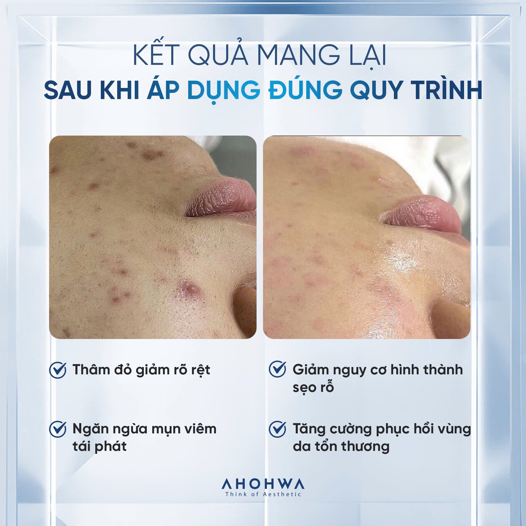 Tế bào gốc kháng viêm phục hồi tái tạo da mụn Ahohwa Azulene Calming Ampoule 80%