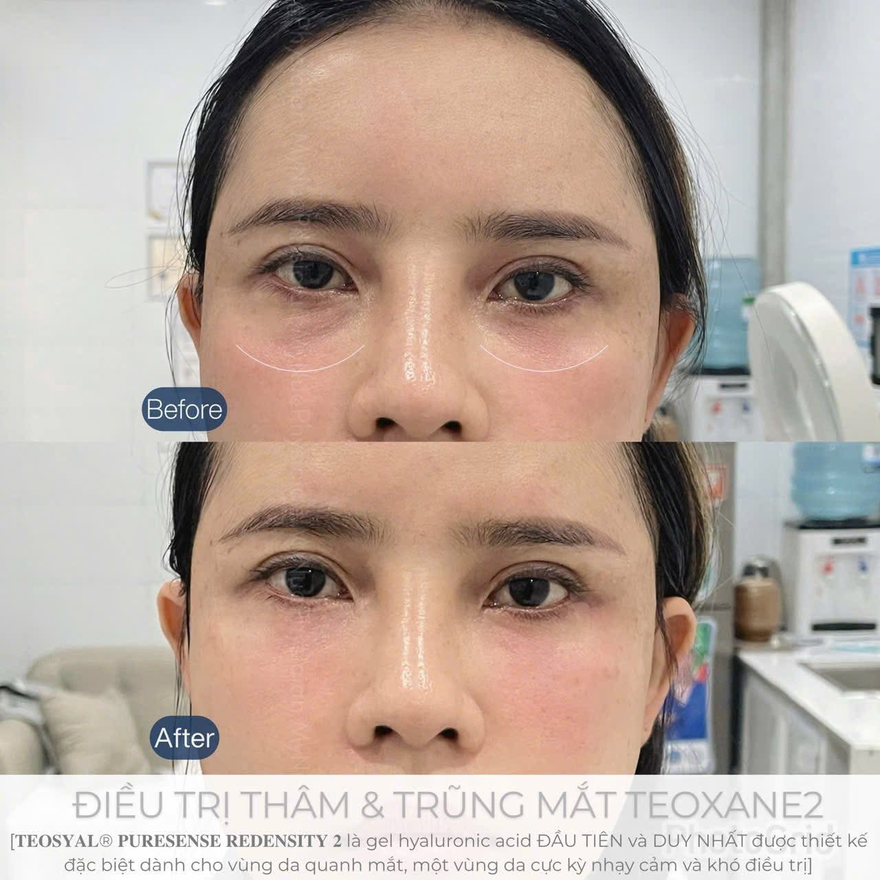Tinh chất Khử thâm quầng mắt Teoxane redensity 2