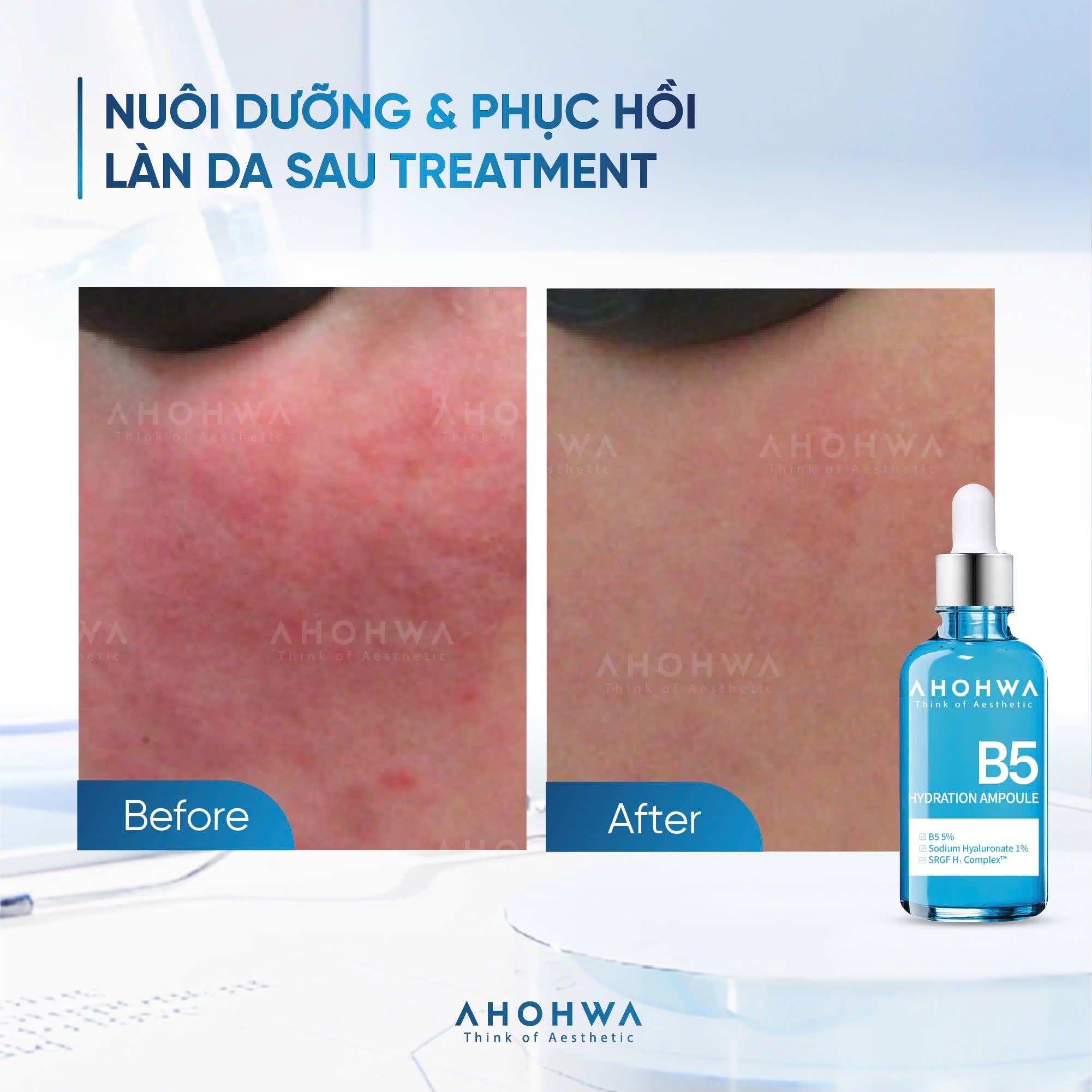 Tinh chất ampoule B5 cấp ẩm phục hồi da Ahohwa Hydration Ampoule B5