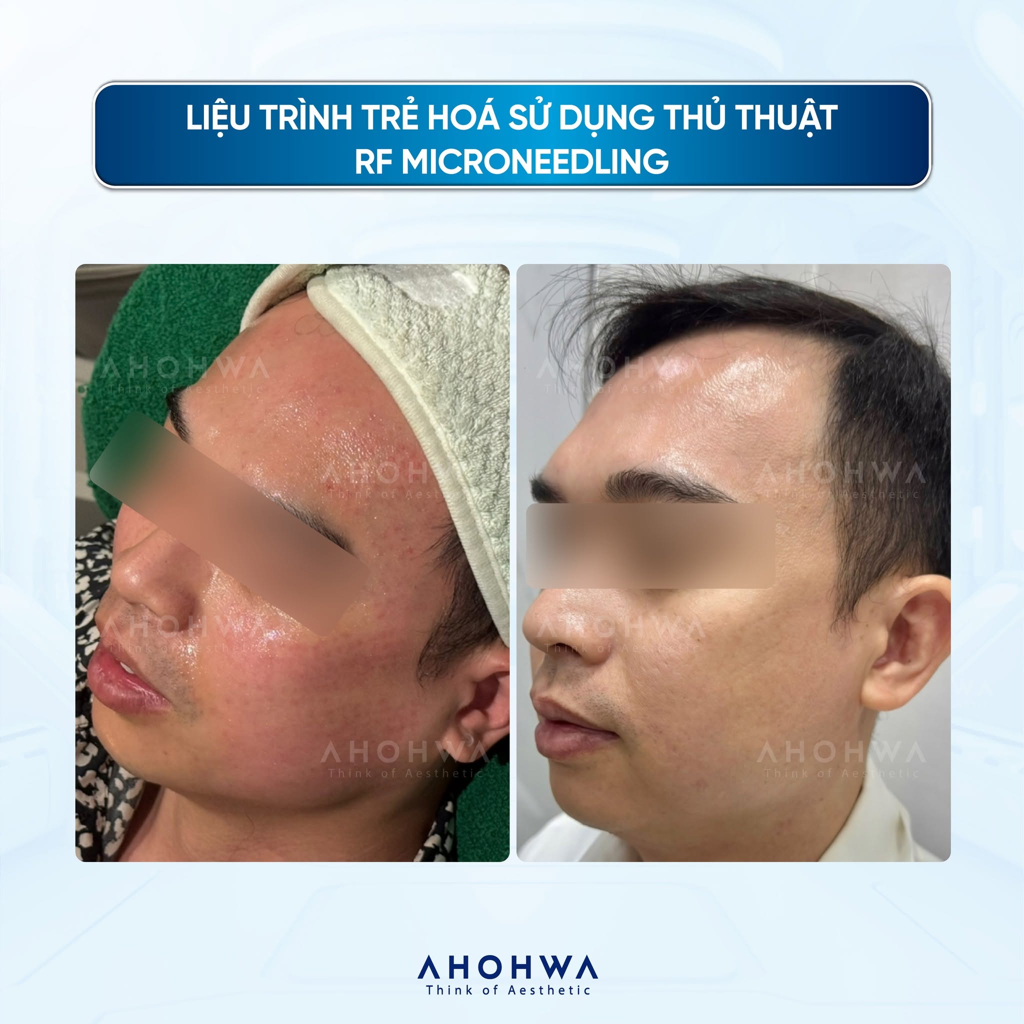 Tinh chất tăng trưởng tế bào gốc Ahohwa SRGF H1 Reset Ampoule