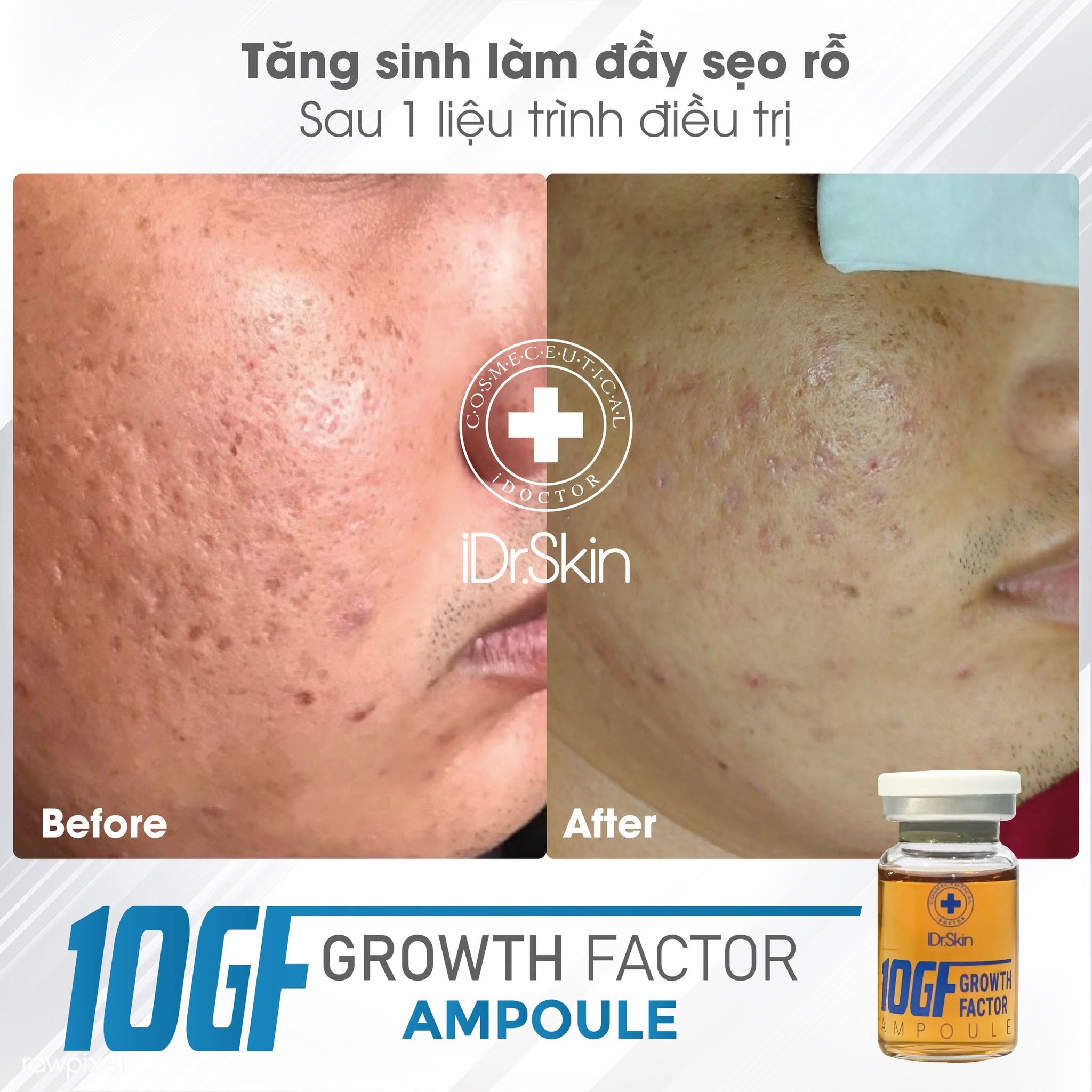 Tinh chất tế bào gốc hỗ trợ cải thiện sẹo rỗ iDr.Skin 10GF Growth Factor 10ml