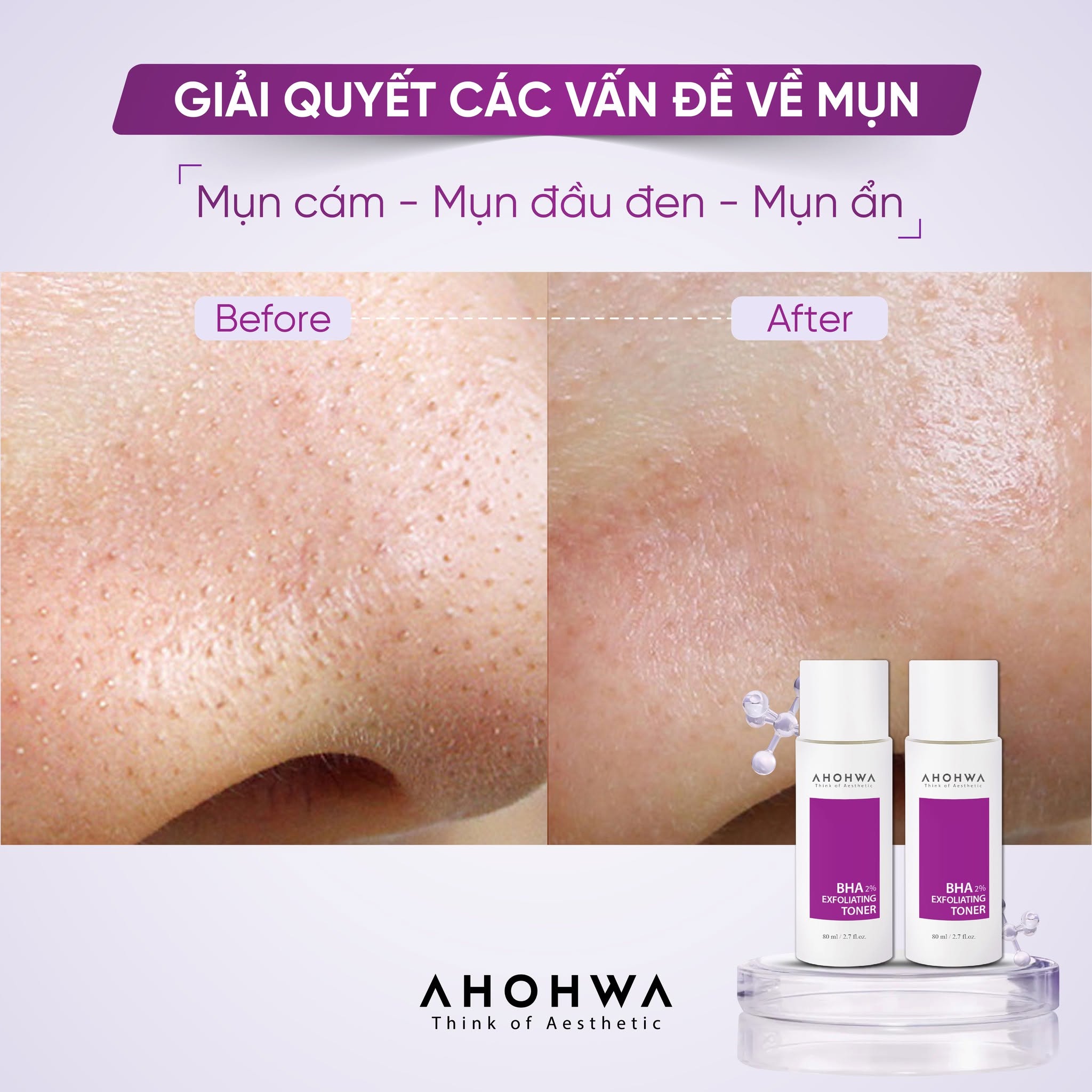 Toner hỗ trợ giảm mụn làm sạch bã nhờn thu nhỏ lỗ chân lông Ahohwa BHA 2% Exfoliating Toner