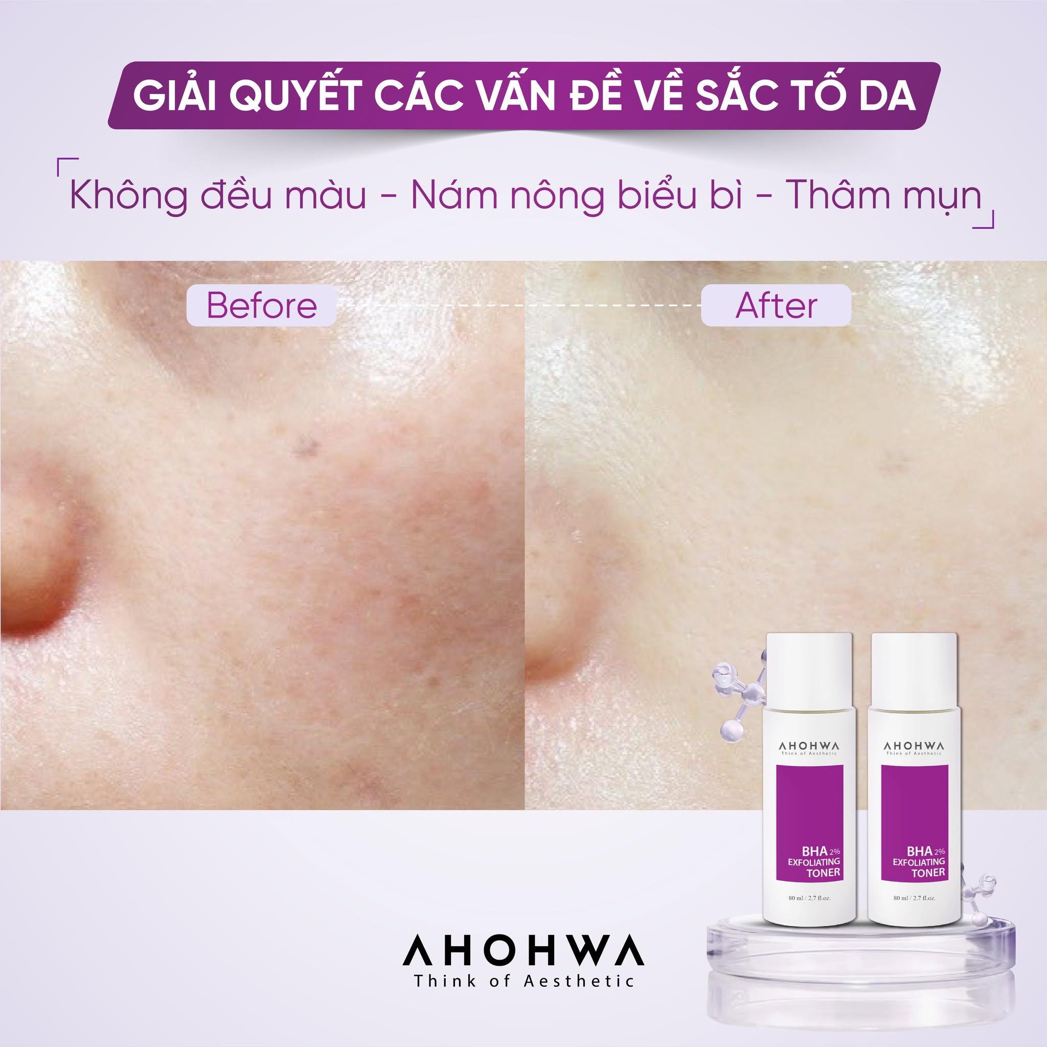Toner hỗ trợ giảm mụn làm sạch bã nhờn thu nhỏ lỗ chân lông Ahohwa BHA 2% Exfoliating Toner