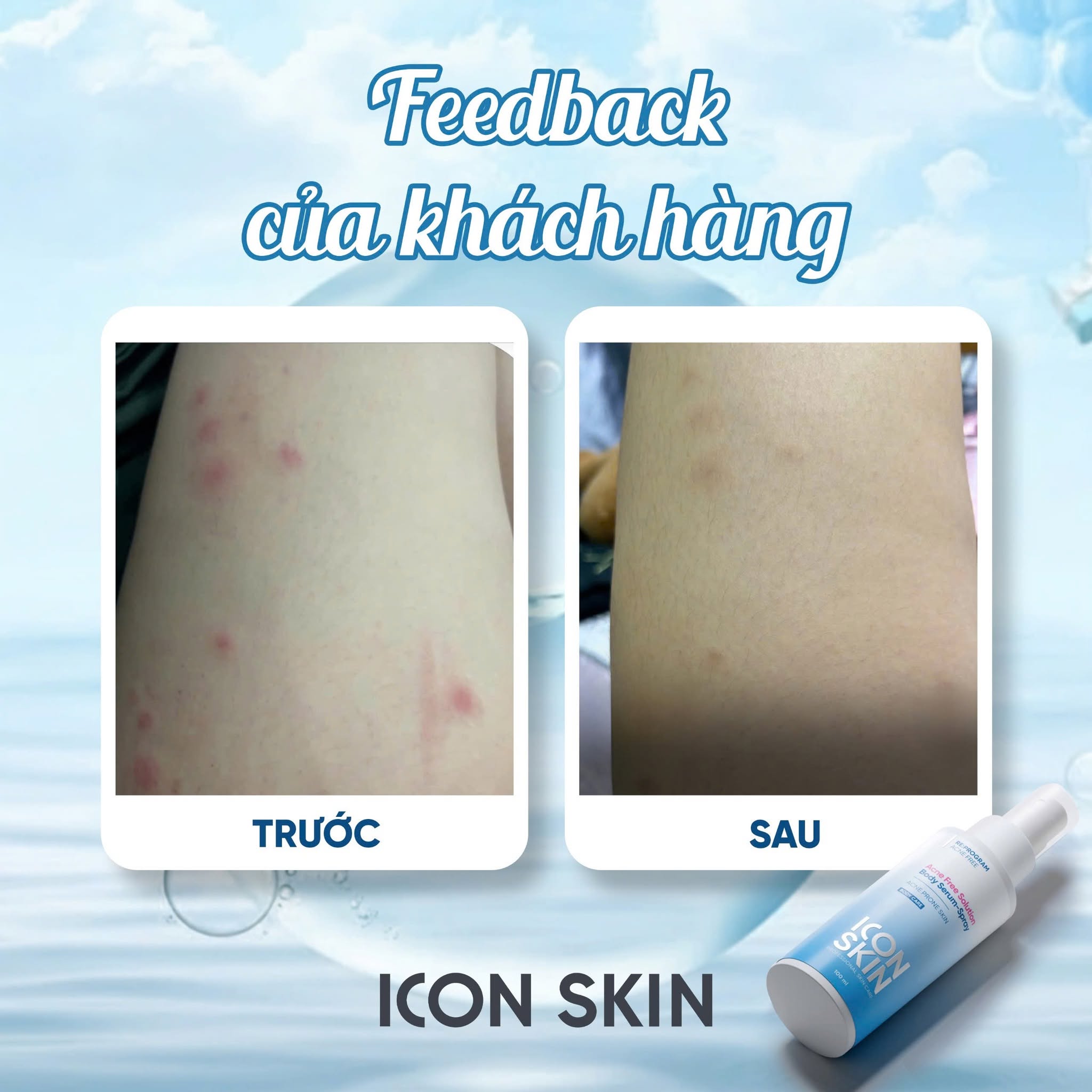 Xịt giảm mụn body cho da mụn Icon Skin Acne Free Solution Body Serum-Spray