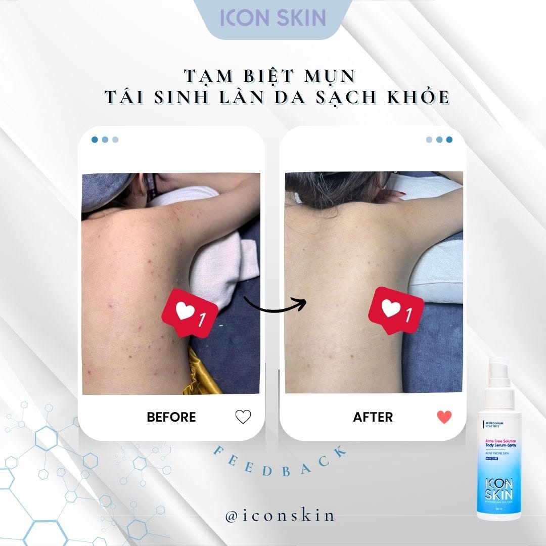 Xịt giảm mụn body cho da mụn Icon Skin Acne Free Solution Body Serum-Spray