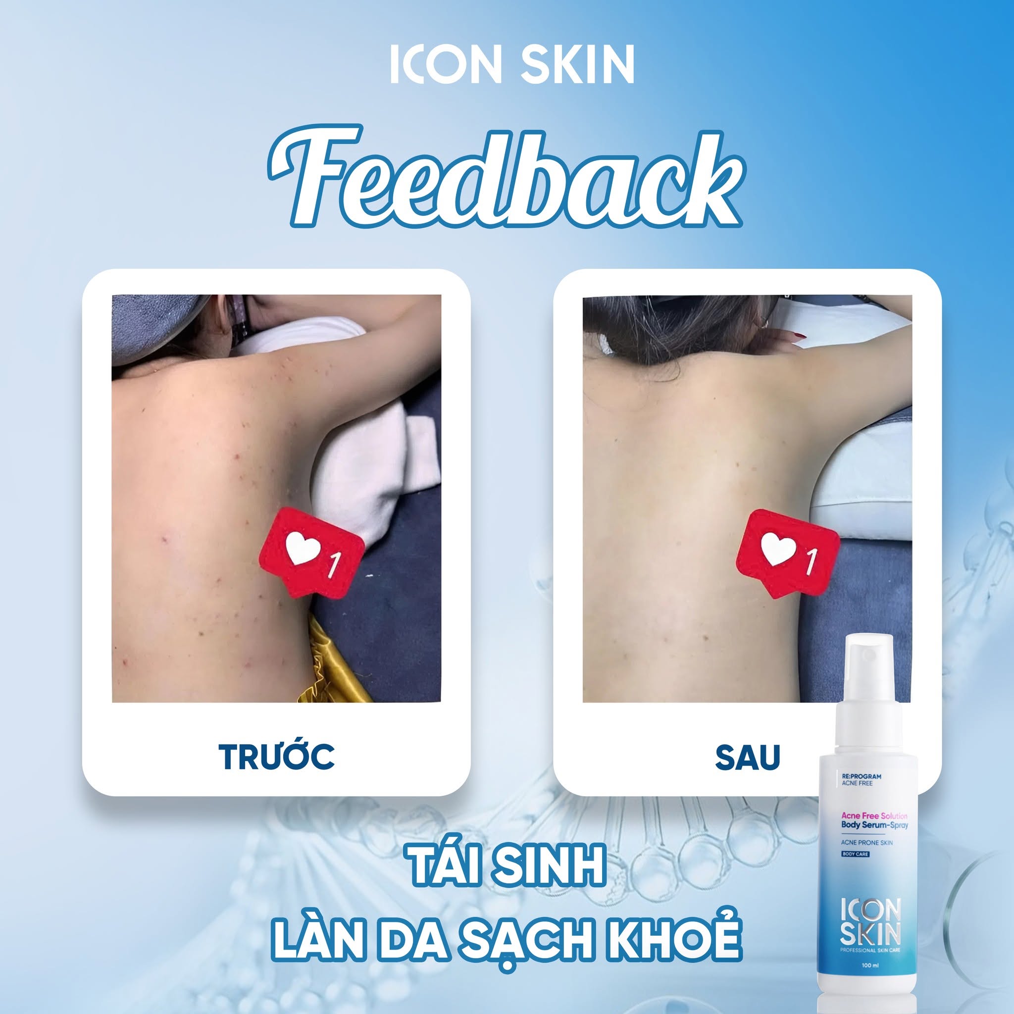 Xịt giảm mụn body cho da mụn Icon Skin Acne Free Solution Body Serum-Spray
