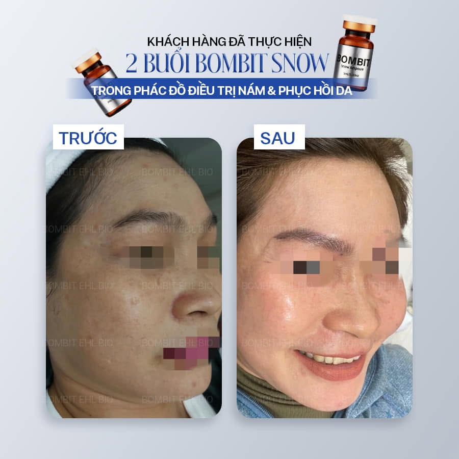 BOMBIT Snow Meso Hỗ Trợ Điều Trị Nám, Sạm Và Làm Sáng Da 4.jpg