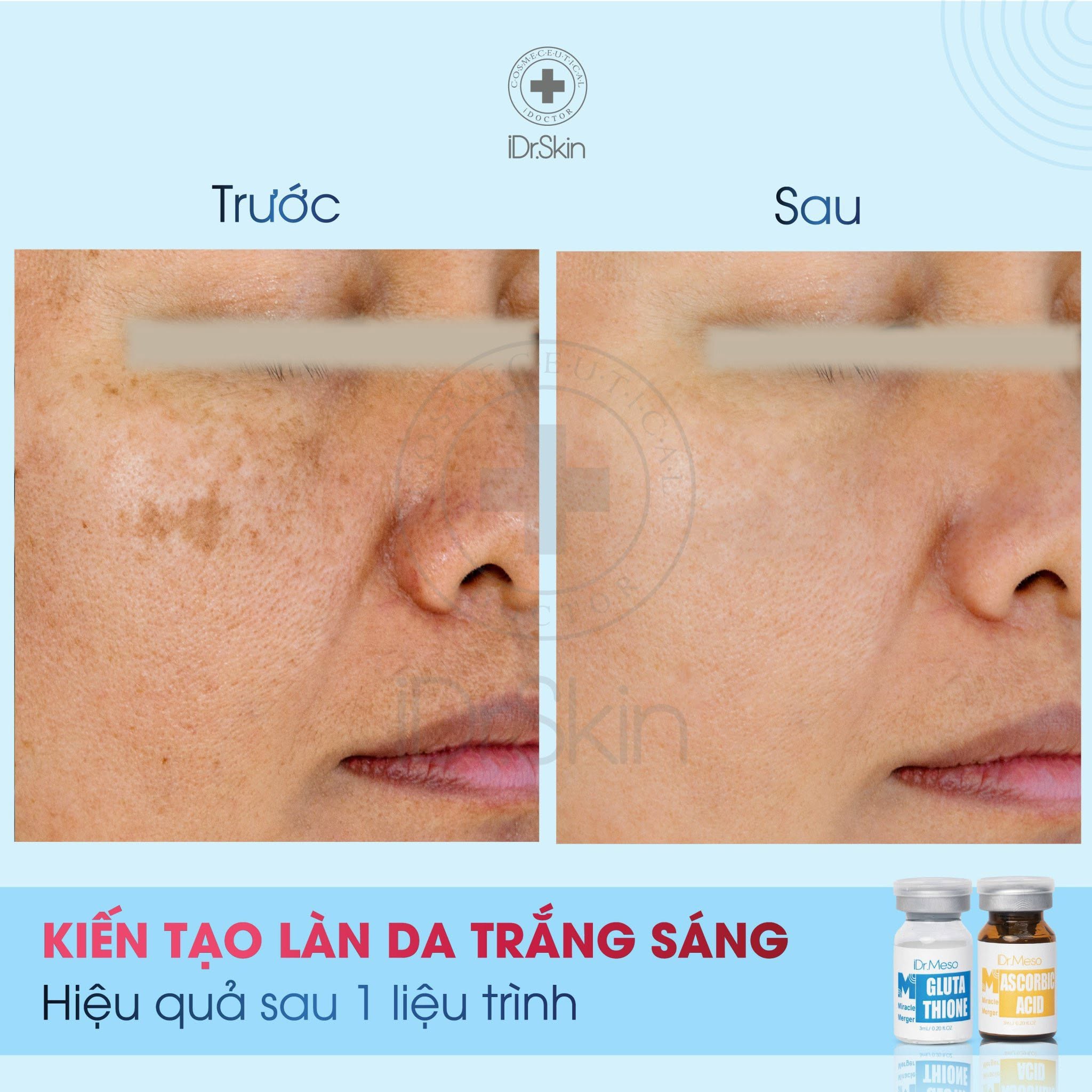 Combo Meso iDr.Skin Vitamin C 20% & Glutathione – Hỗ Trợ Mờ Nám, Dưỡng Sáng Da 3.jpg