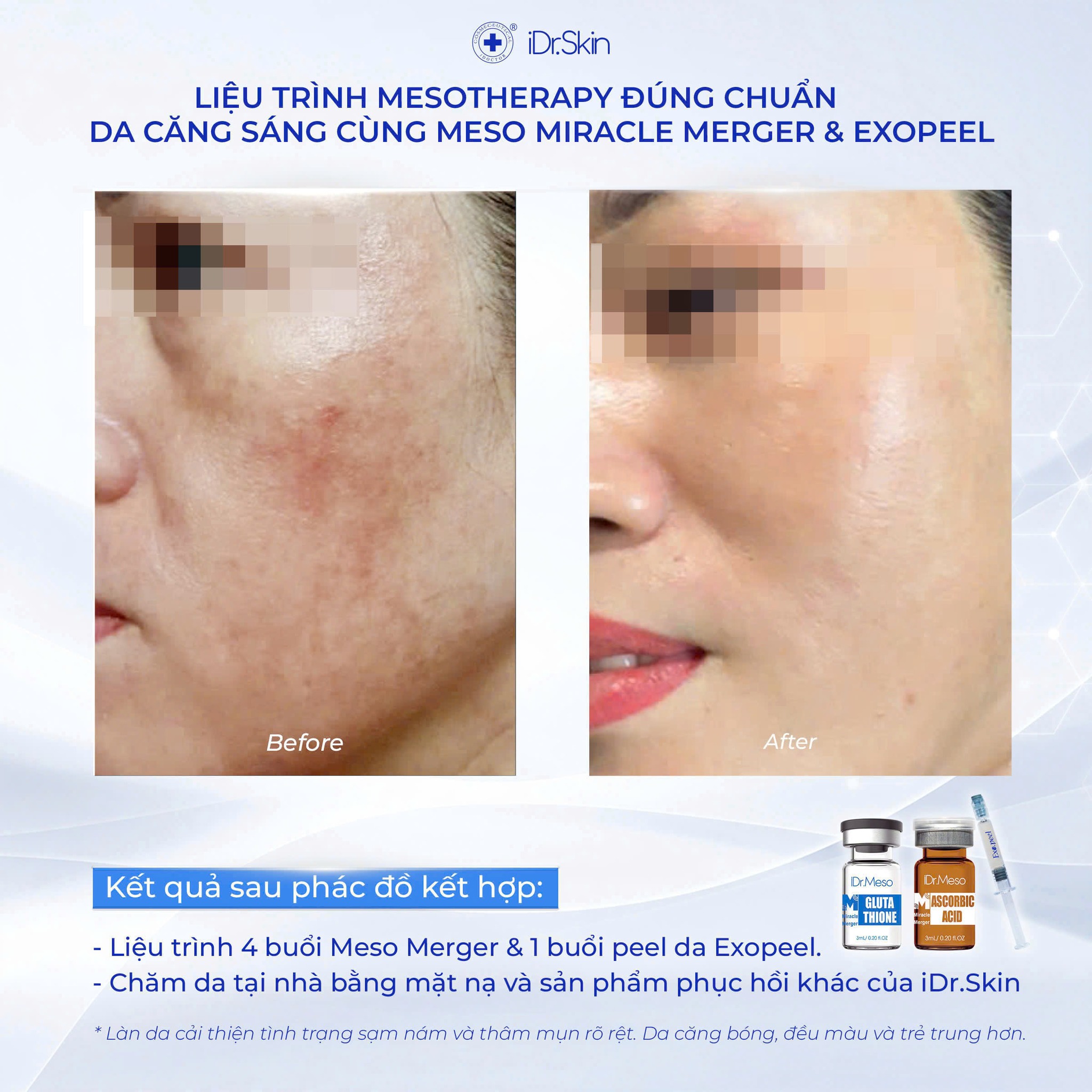 Combo-meso-Idr-Skin-vitamin-C-20-va-Glutathion-trang-sang-da_Combo meso Idr.Skin vitamin C 20% và Glutathion trắng sáng da.jpg