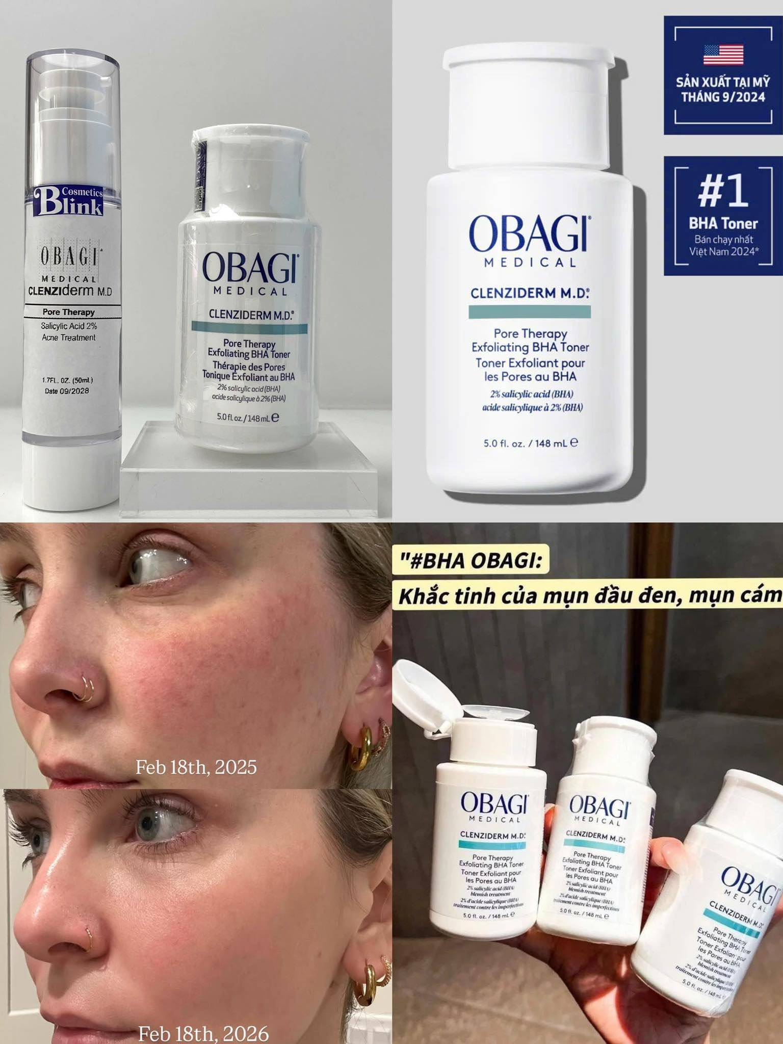 Dung-dich-tay-da-chet-ngua-mun-BHA-Obagi-Clenziderm-MD-Pore-Therapy-148ml-3.jpg?v=1775876391