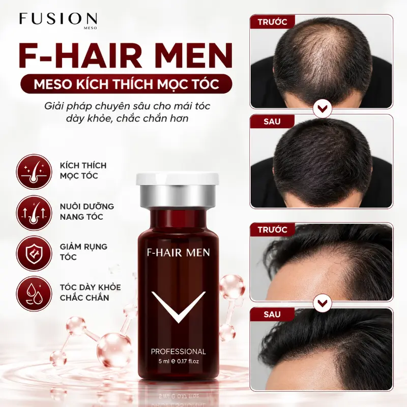 Fusion F-Hair Men cấy điều trị rụng tóc, phục hồi tóc từ gốc tới ngọn 6.webp