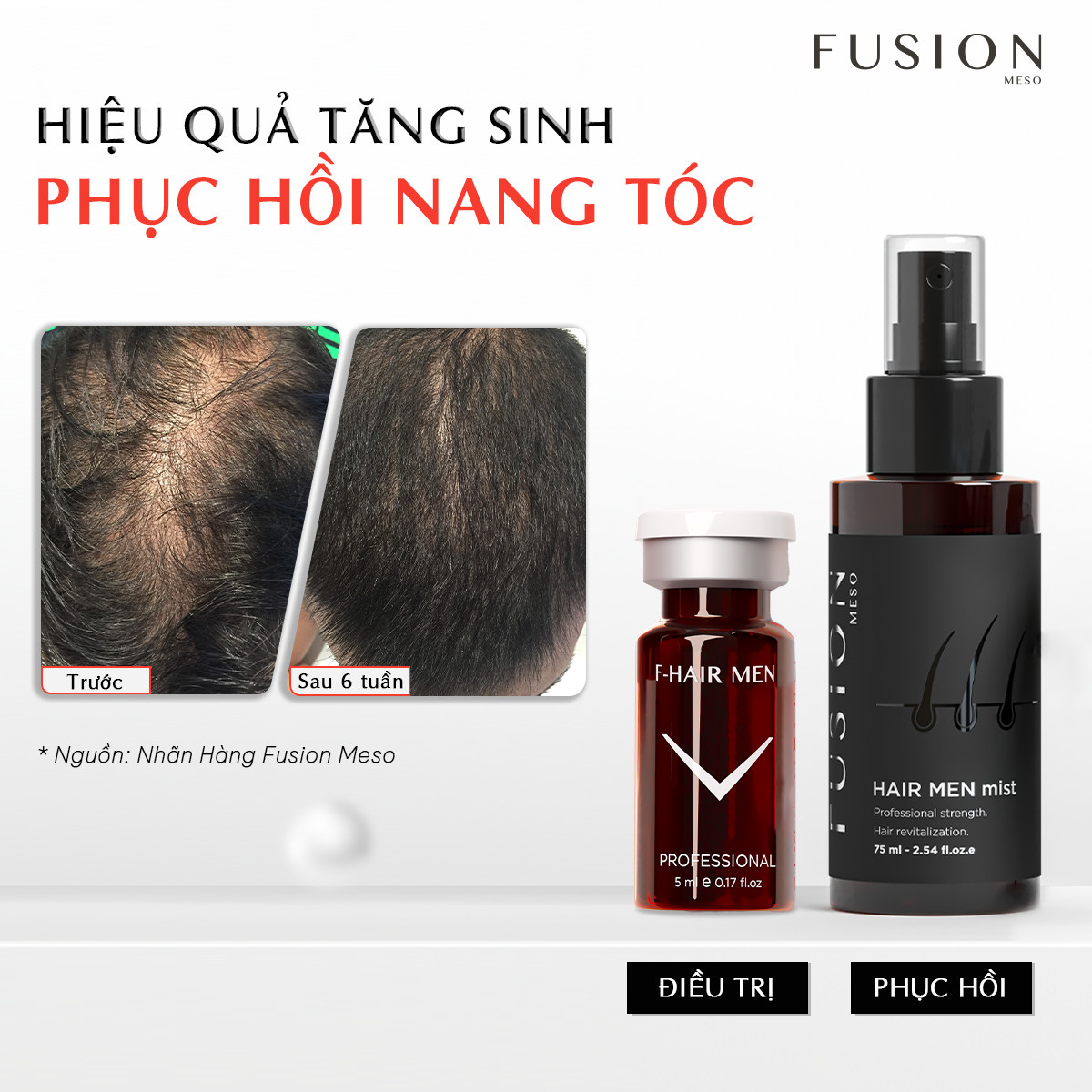 Fusion-F-Hair-Men-cay-dieu-tri-rung-toc-phuc-hoi-toc-tu-goc-toi-ngon-Fusion-Mesotherapy_Fusion F-Hair Men cấy điều trị rụng tóc, phục hồi tóc từ gốc tới ngọn.jpg