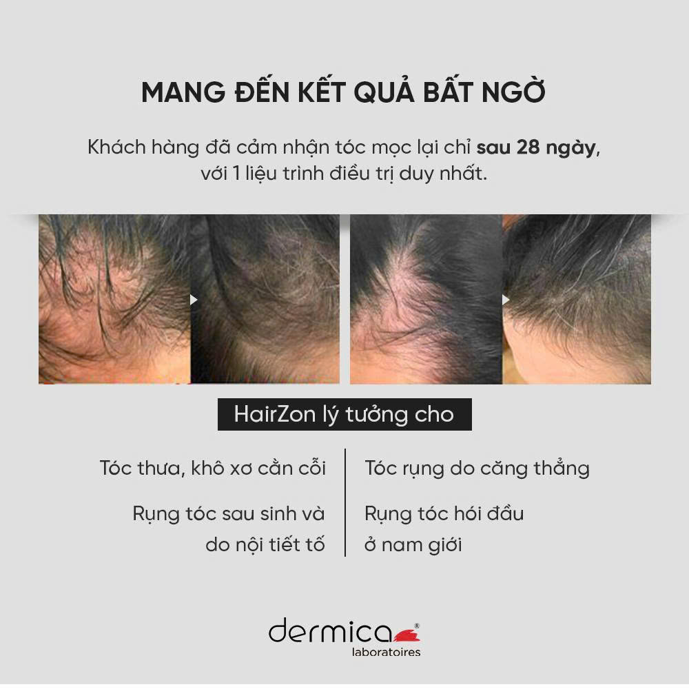 Hairzon-Huyet-thanh-kich-thich-moc-toc-giam-gay-rung-Hop-10-ong-x-2ml_Hairzon - Huyết thanh kích thích mọc tóc, giảm gãy rụng.jpg