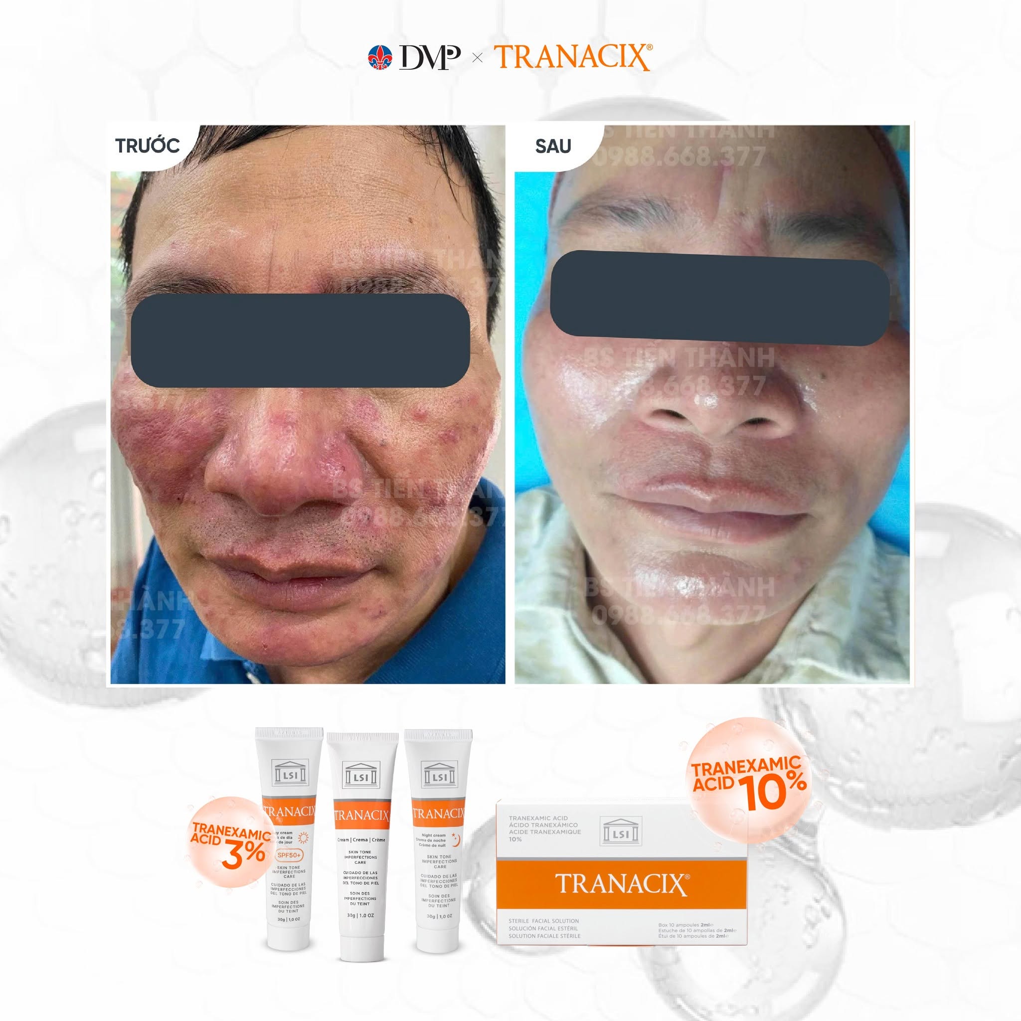 Kem Bôi Tranexamic Acid Hỗ Trợ Cải Thiện Nám, Hồng Ban Và Tăng Sắc Tố Tranacix Cream 3% 10.jpg