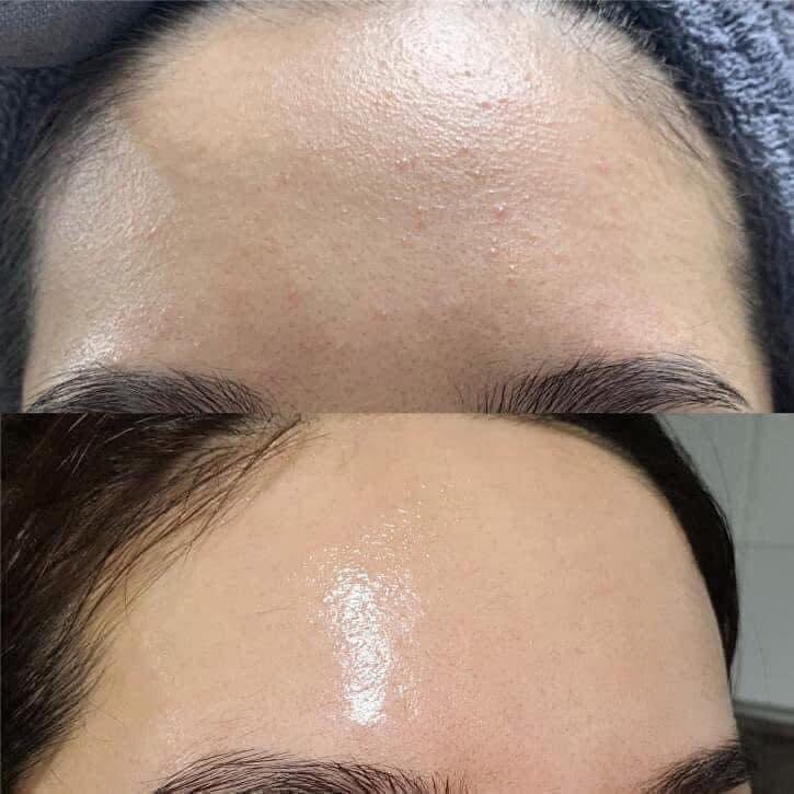 Kem-tri-mun-tri-nam-tre-hoa-da-OBAGI-Tretinoin-0-05-20g-3.jpg?v=1775873989