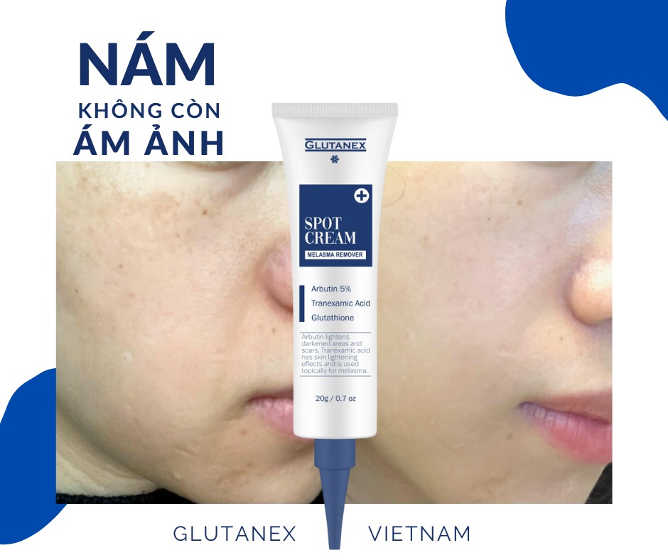 Kem-tri-nam-Arbutin-5-Tranexxamic-acid-Glutathione-Glutanex-Spot-Cream-Melasma-Remover-20g-7.jpg?v=1776245658