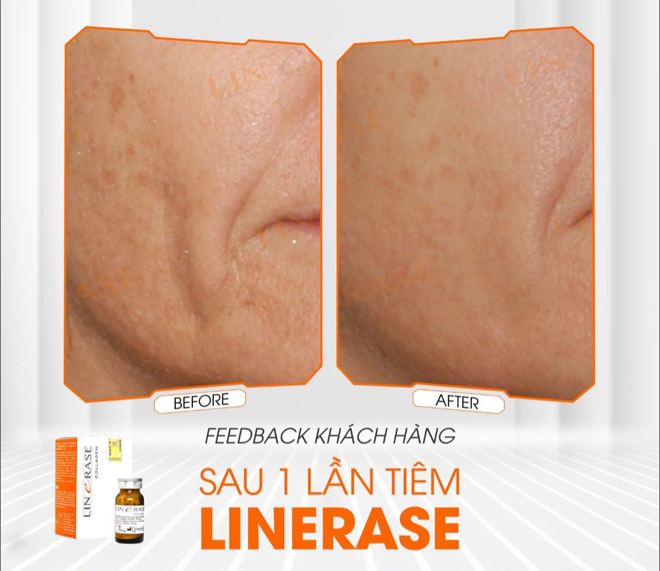 LINERASE COLLAGEN - PHỤC HỒI VÀ TÁI TẠO THẾ HỆ MỚI 1.jpg